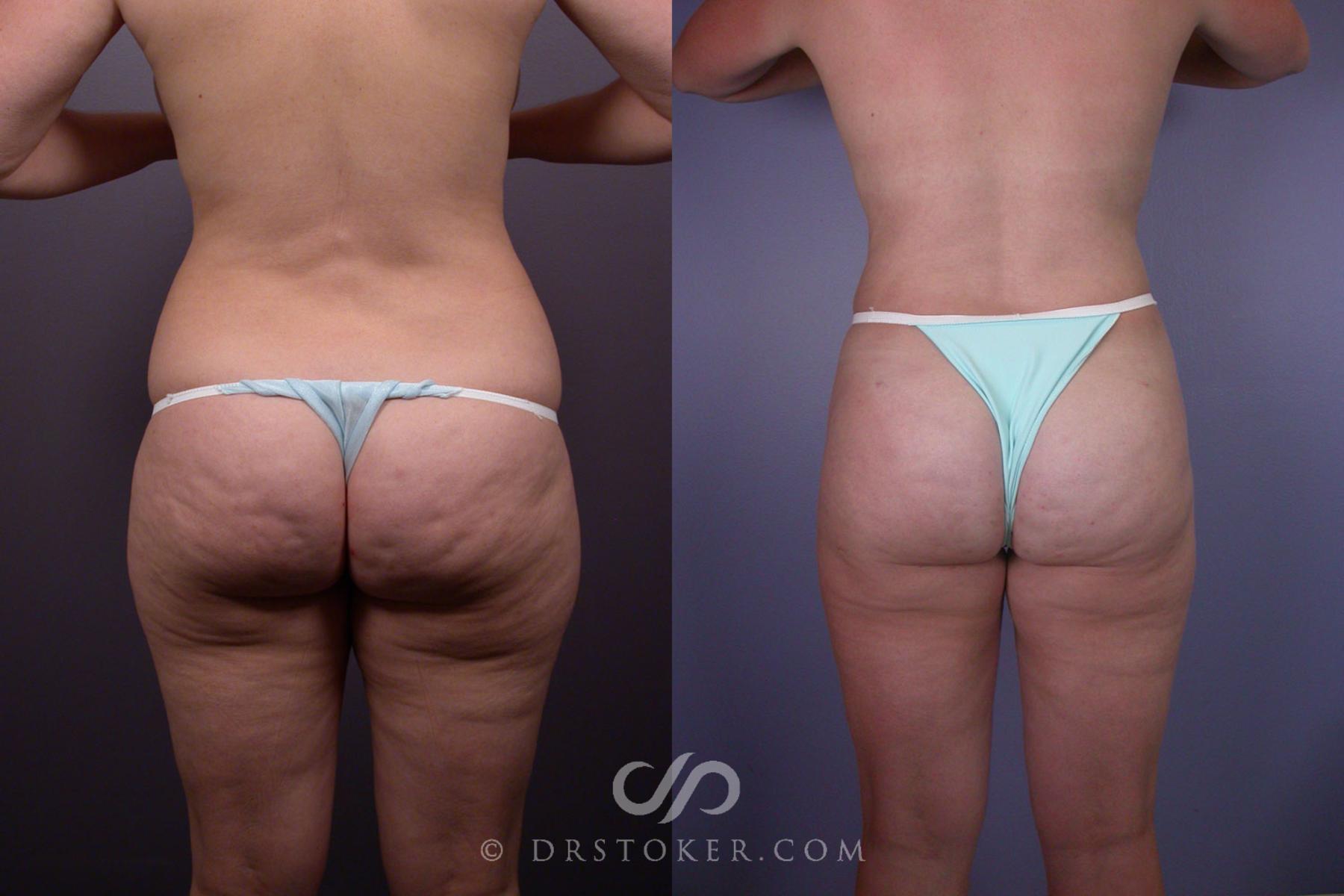 Before & After Liposuction Case 90 View #5 View in Los Angeles, CA