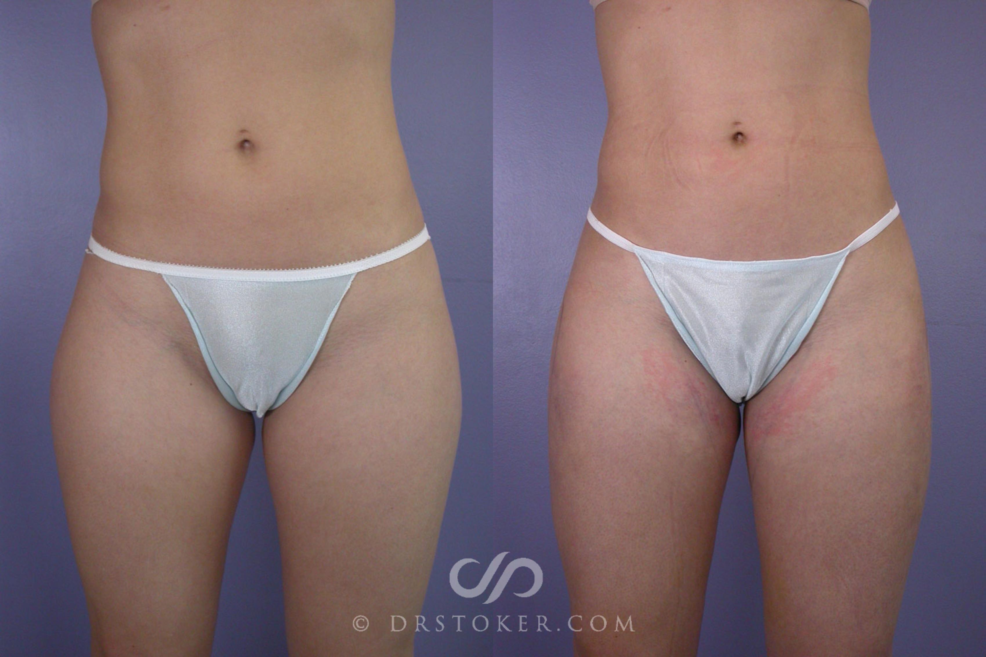 Before & After Liposuction Case 91 View #1 View in Los Angeles, CA