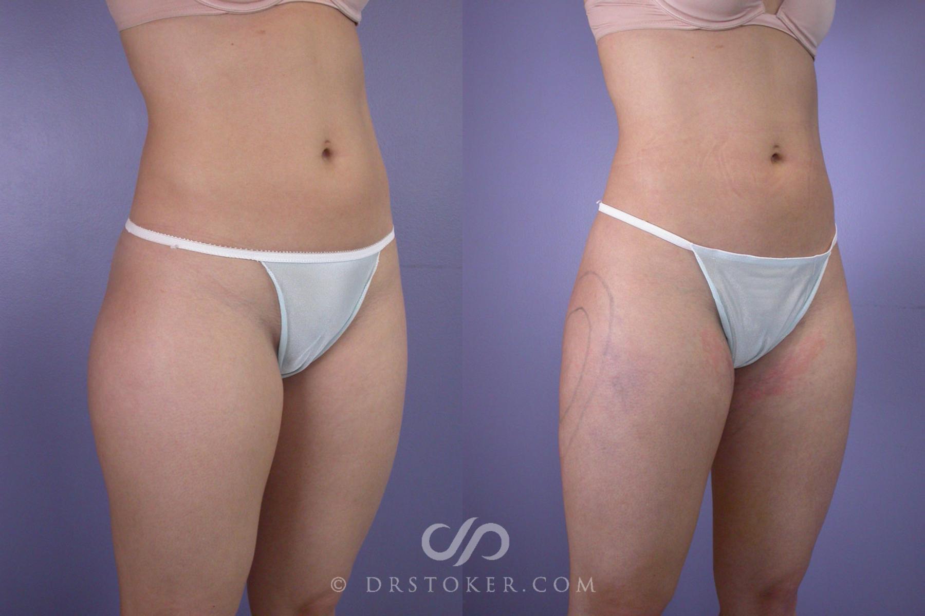 Before & After Liposuction Case 91 View #2 View in Los Angeles, CA