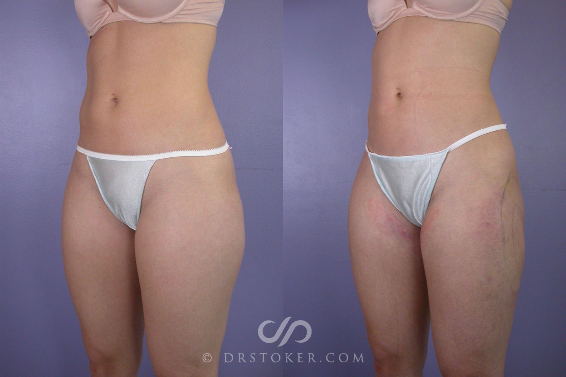 Before & After Liposuction Case 91 View #3 View in Los Angeles, CA