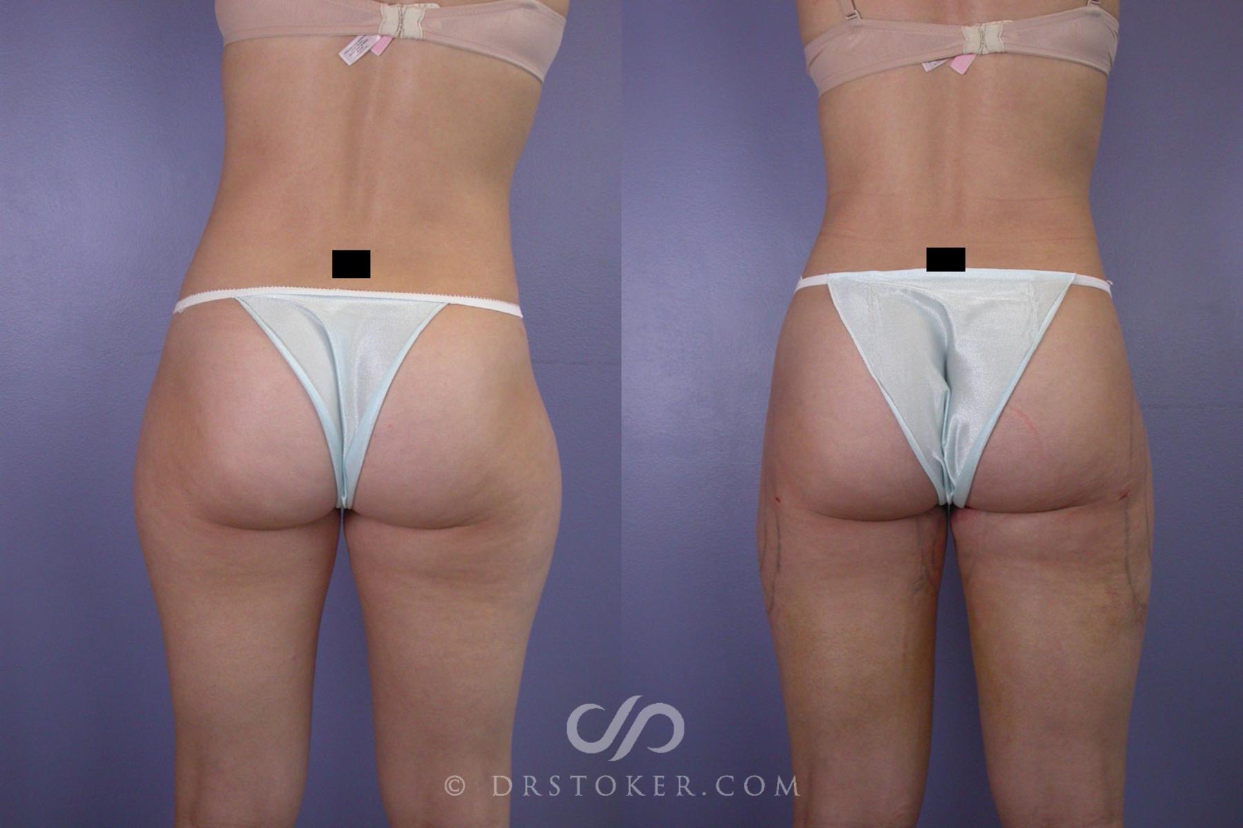 Before & After Liposuction Case 91 View #4 View in Los Angeles, CA