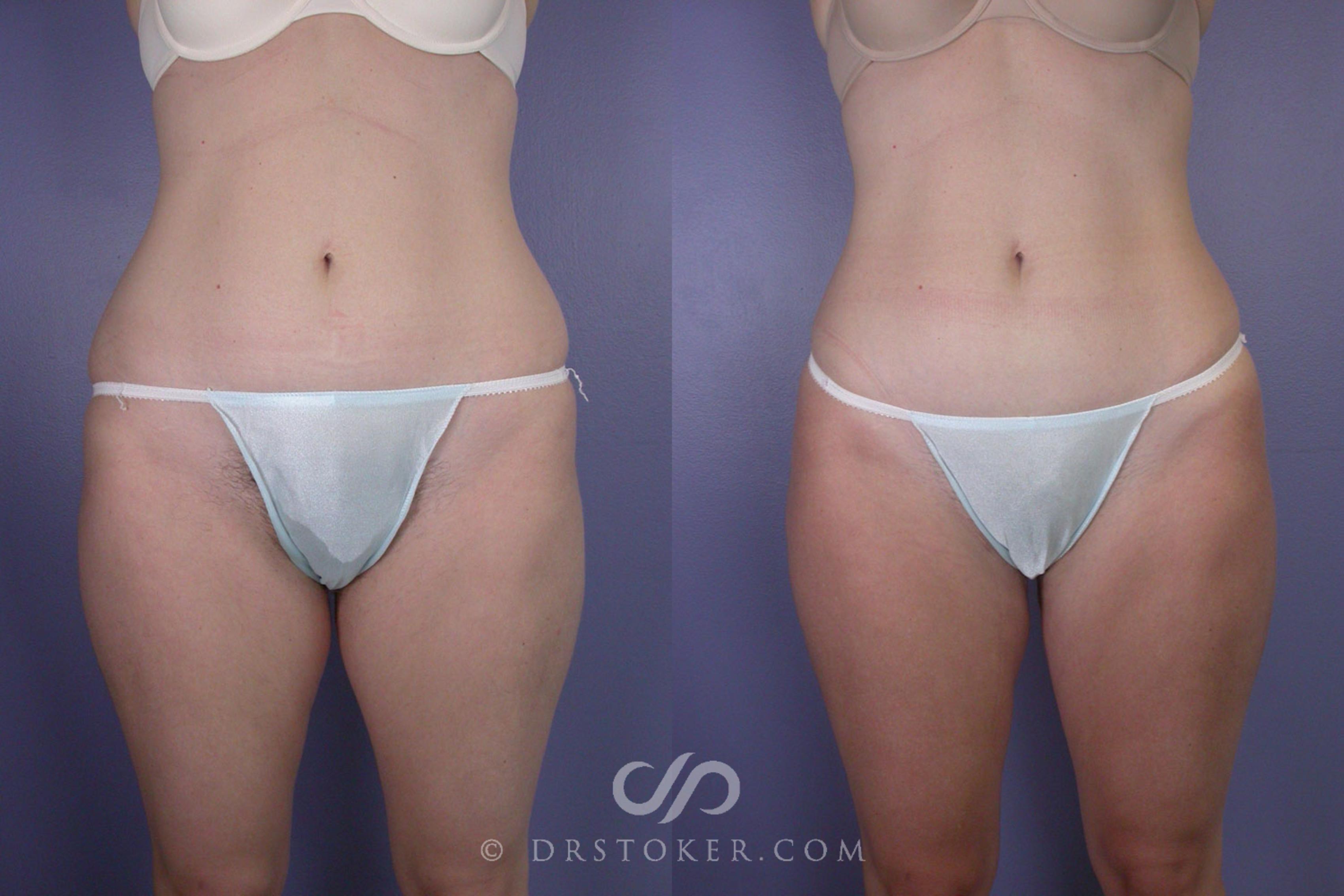 Before & After Liposuction Case 93 View #1 View in Los Angeles, CA