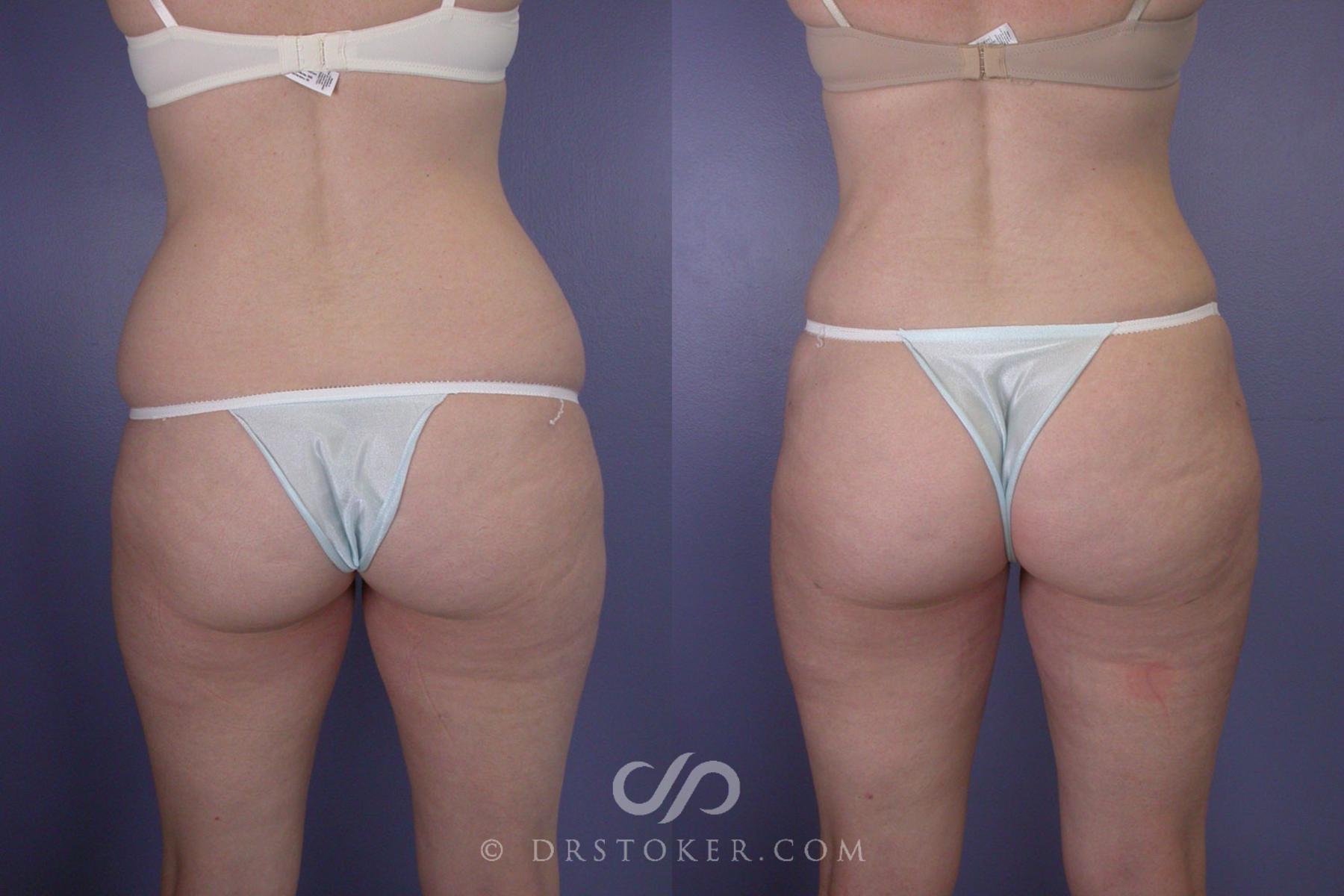 Before & After Liposuction Case 93 View #2 View in Los Angeles, CA
