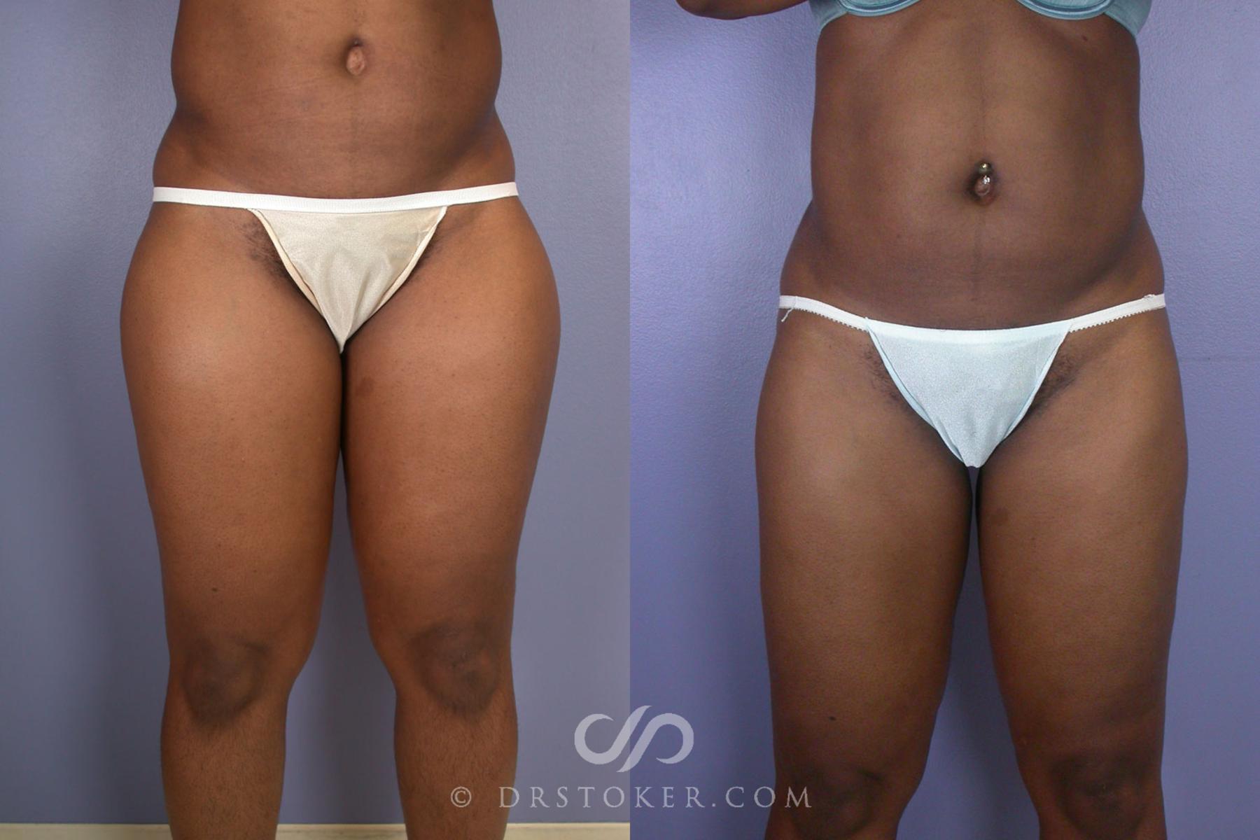 Before & After Liposuction Case 95 View #1 View in Los Angeles, CA