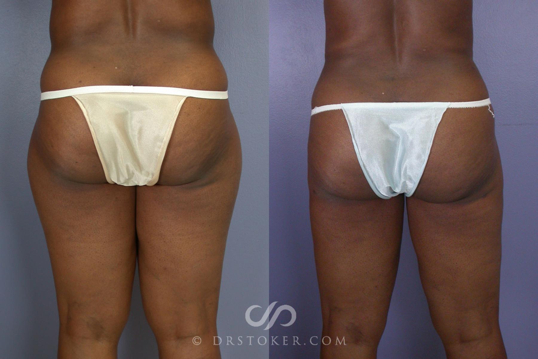 Before & After Liposuction Case 95 View #2 View in Los Angeles, CA