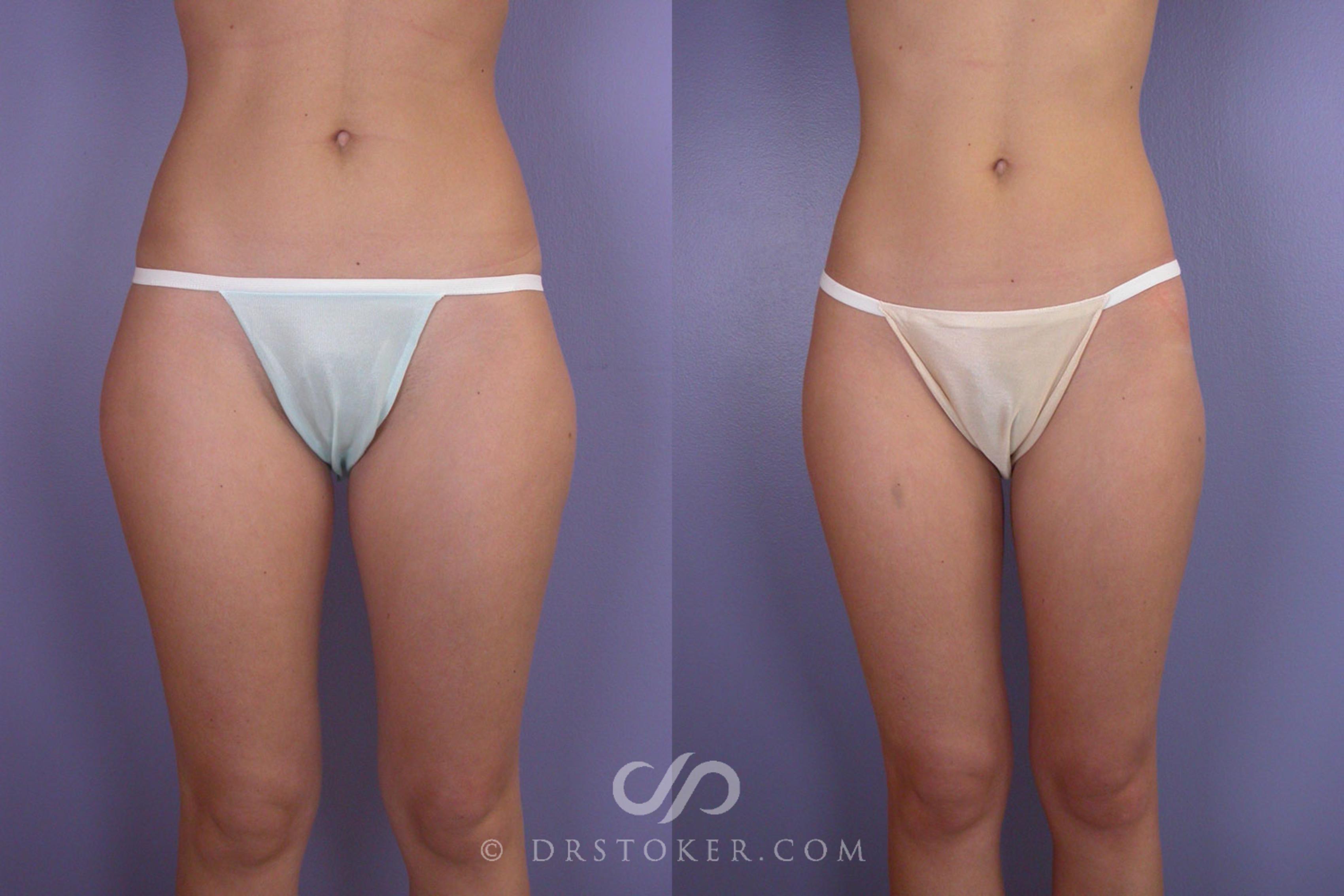 Before & After Liposuction Case 97 View #1 View in Los Angeles, CA