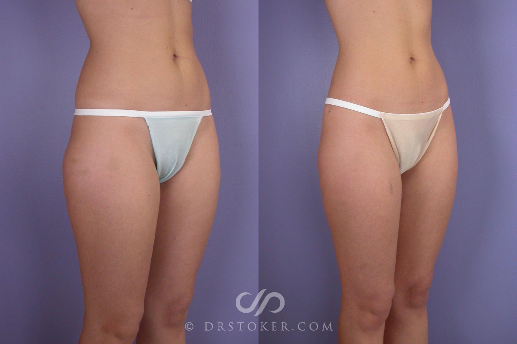 Before & After Liposuction Case 97 View #2 View in Los Angeles, CA