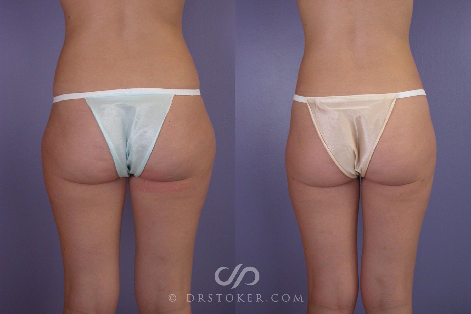 Before & After Liposuction Case 97 View #3 View in Los Angeles, CA