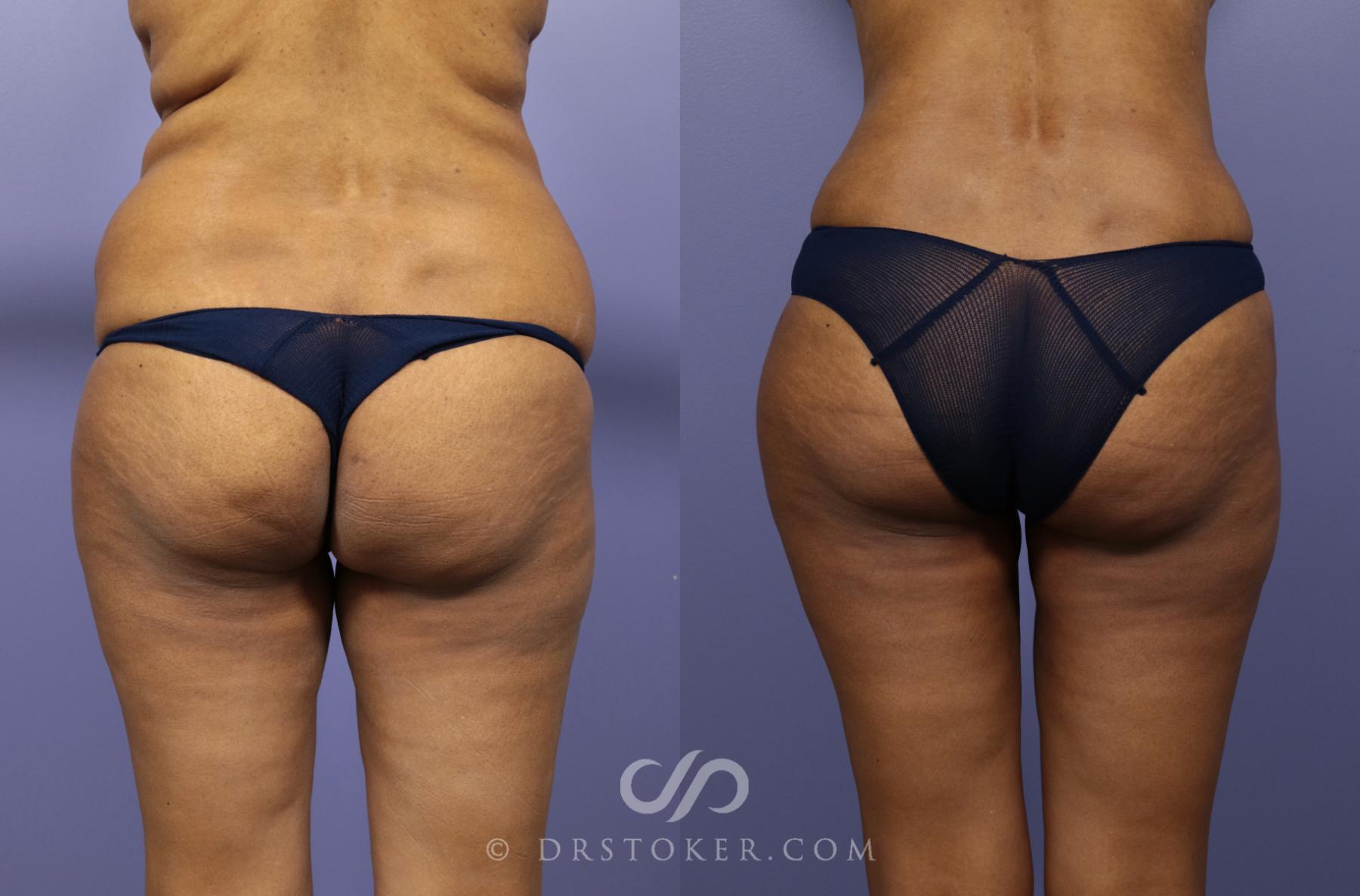 Before & After Liposuction Case 976 View #1 View in Los Angeles, CA
