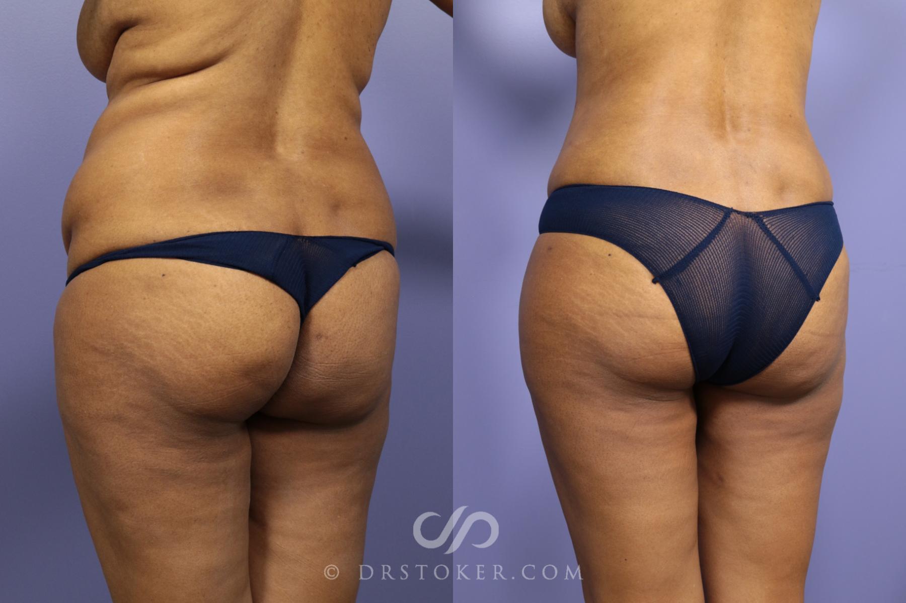 Before & After Liposuction Case 976 View #2 View in Los Angeles, CA