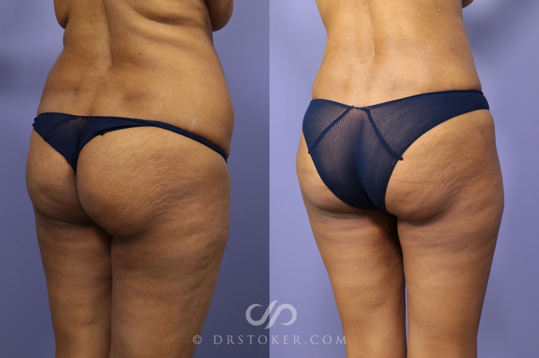 Before & After Liposuction Case 976 View #3 View in Los Angeles, CA