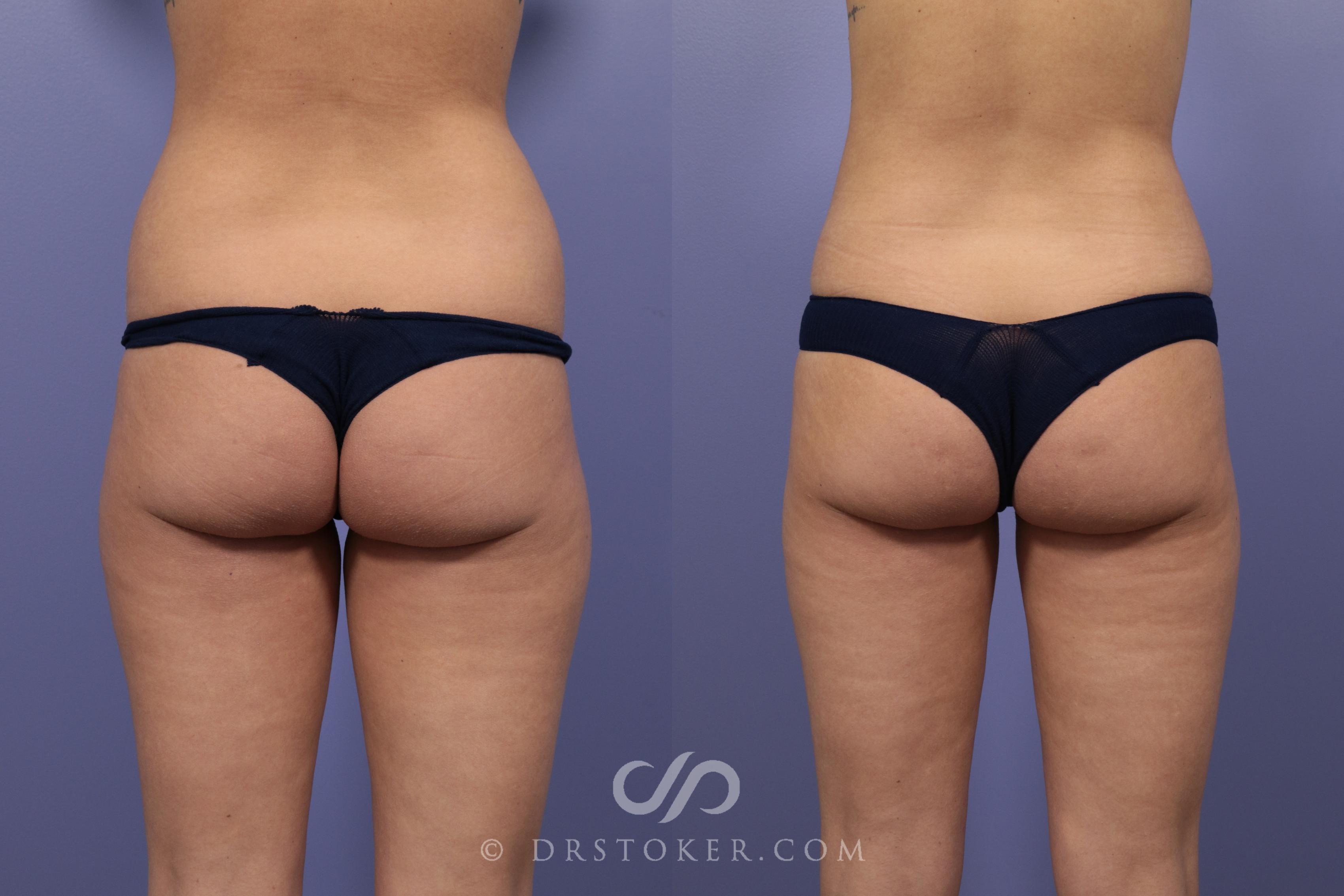 Before & After Liposuction Case 977 View #1 View in Los Angeles, CA