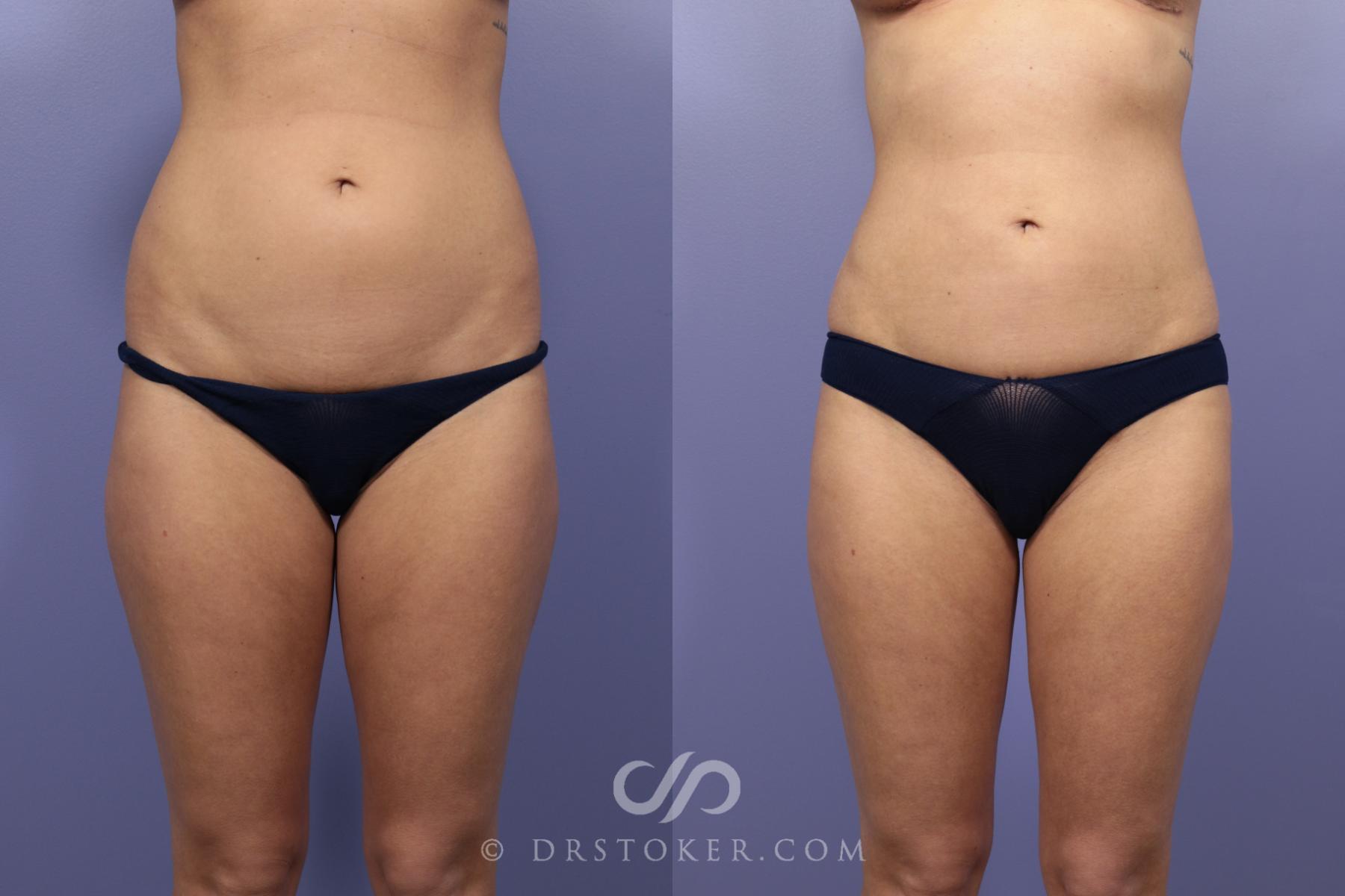 Before & After Liposuction Case 978 View #1 View in Los Angeles, CA