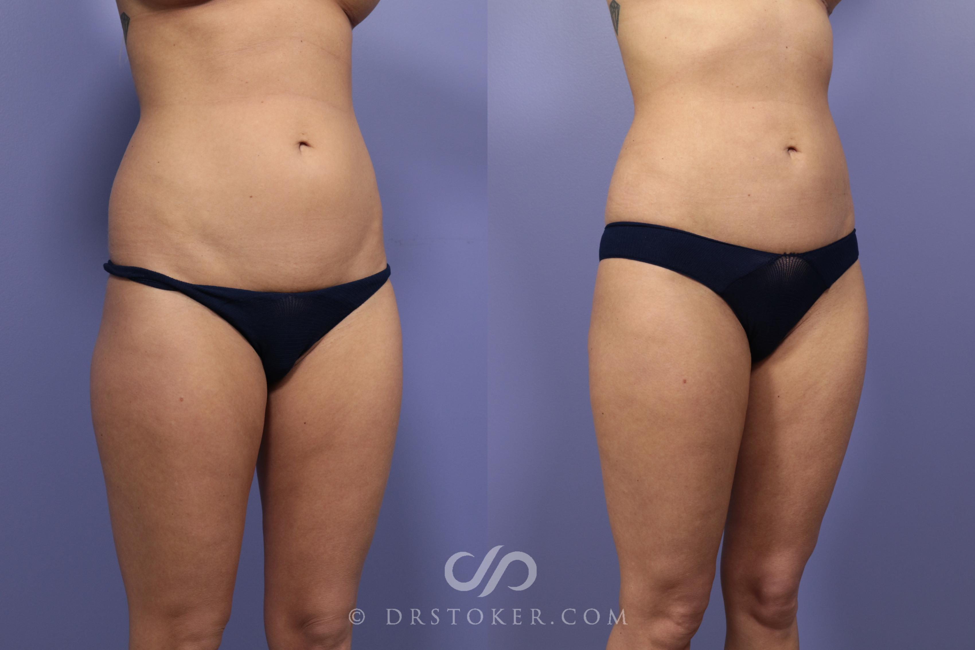 Before & After Liposuction Case 978 View #2 View in Los Angeles, CA