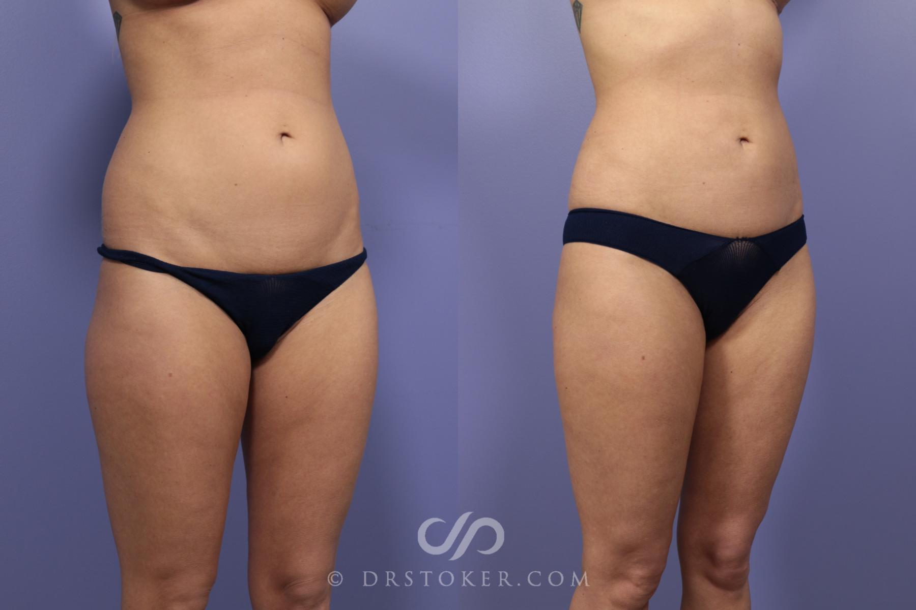 Before & After Liposuction Case 978 View #2 View in Los Angeles, CA