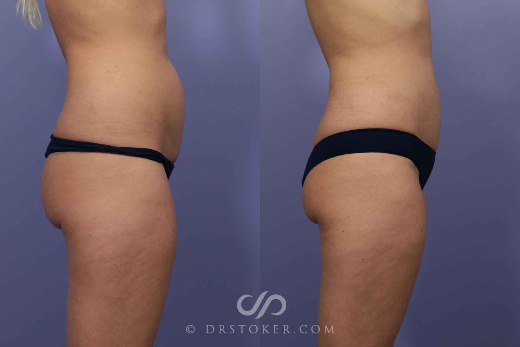 Before & After Liposuction Case 979 View #1 View in Los Angeles, CA