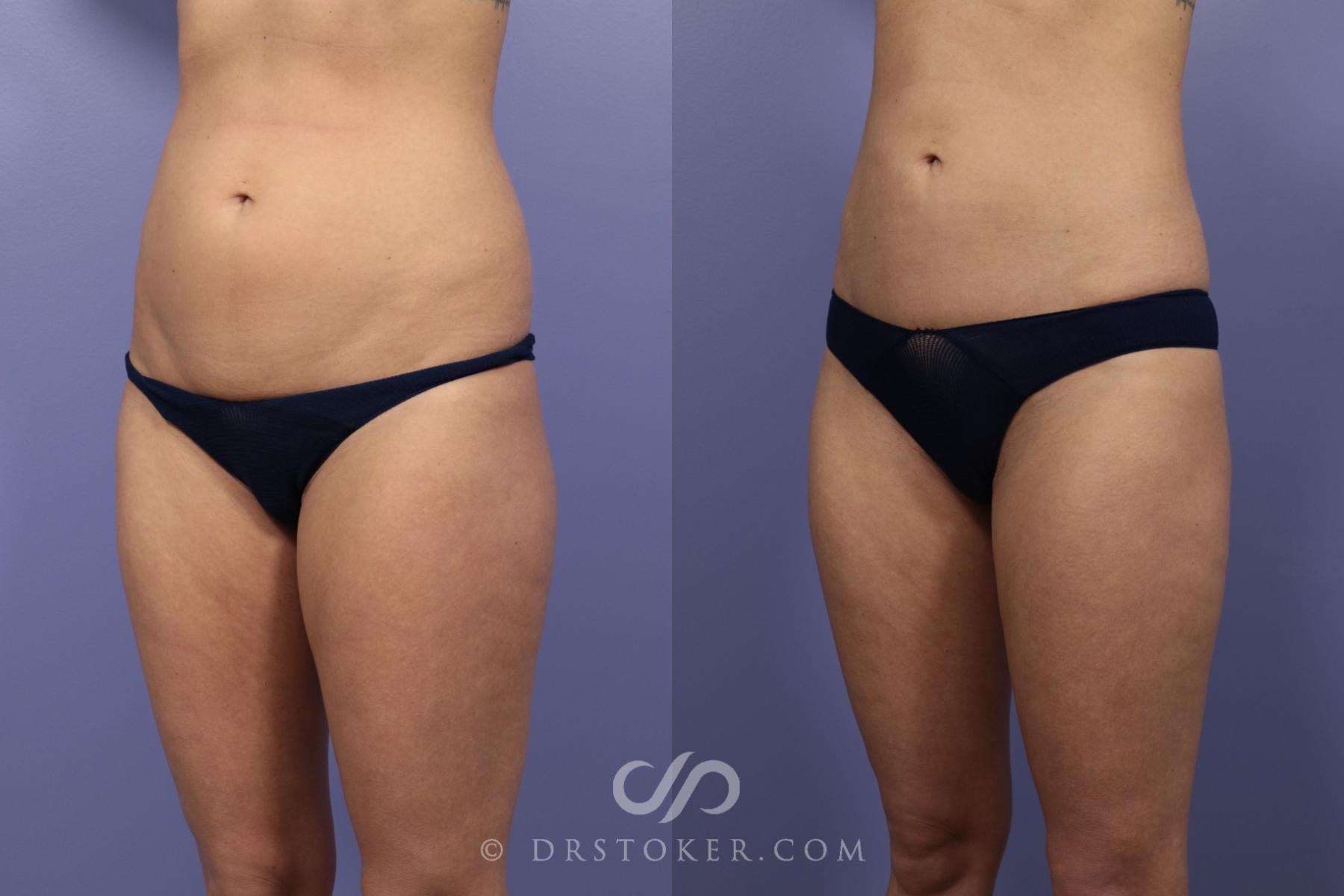 Before & After Liposuction Case 979 View #2 View in Los Angeles, CA