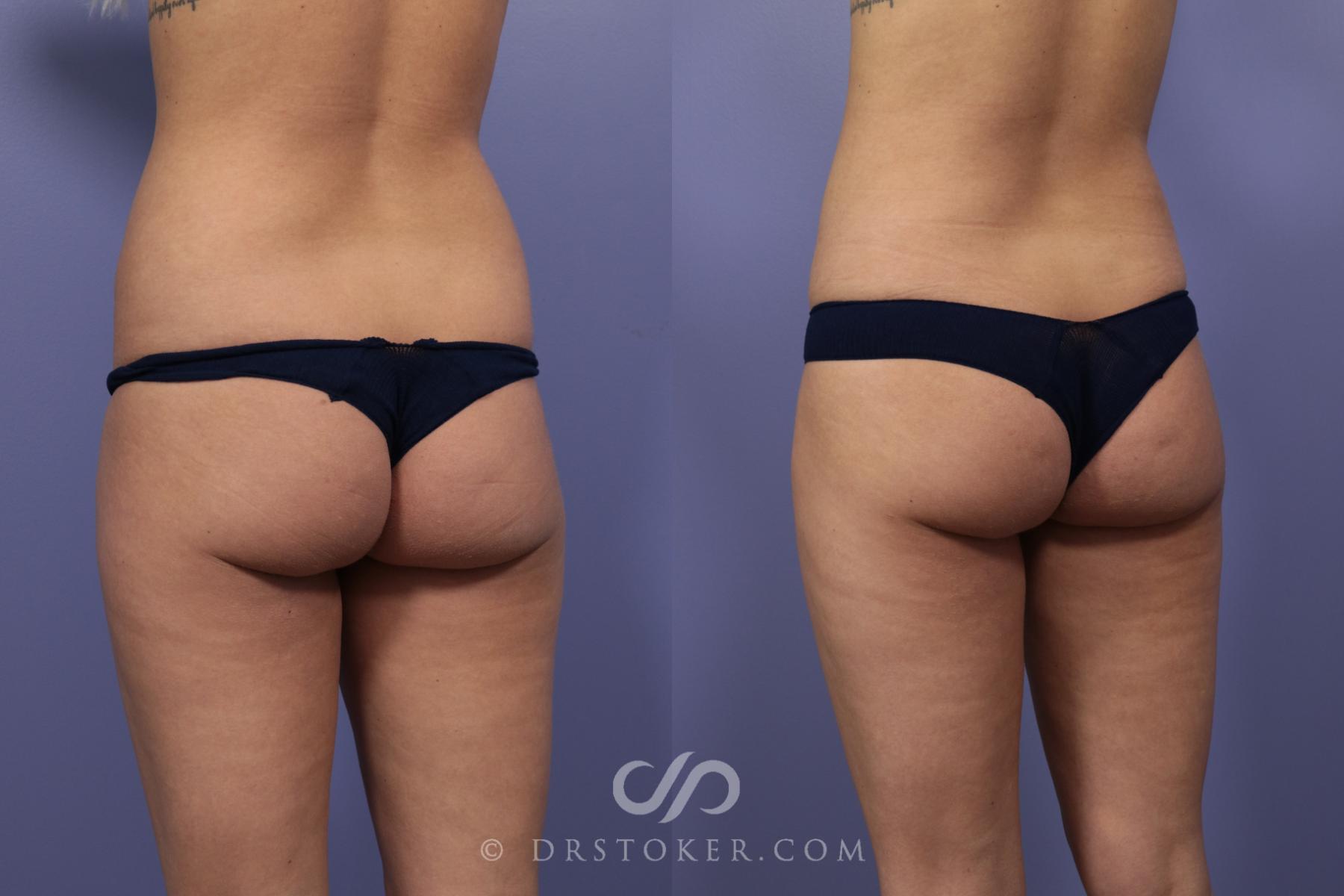 Before & After Liposuction Case 980 View #1 View in Los Angeles, CA