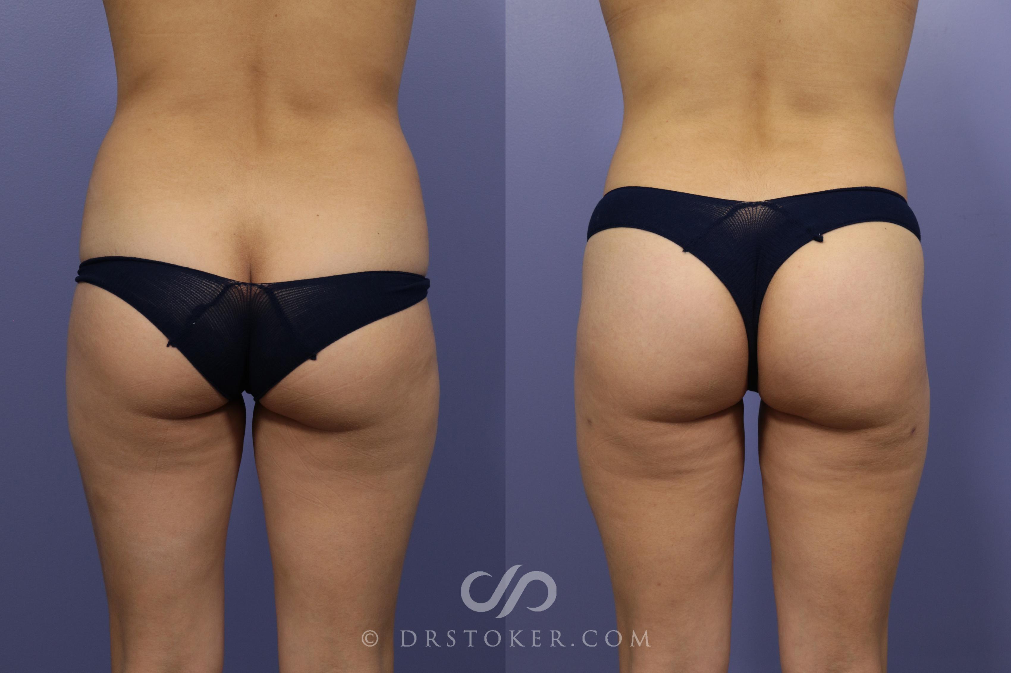 Before & After Liposuction Case 982 View #1 View in Los Angeles, CA