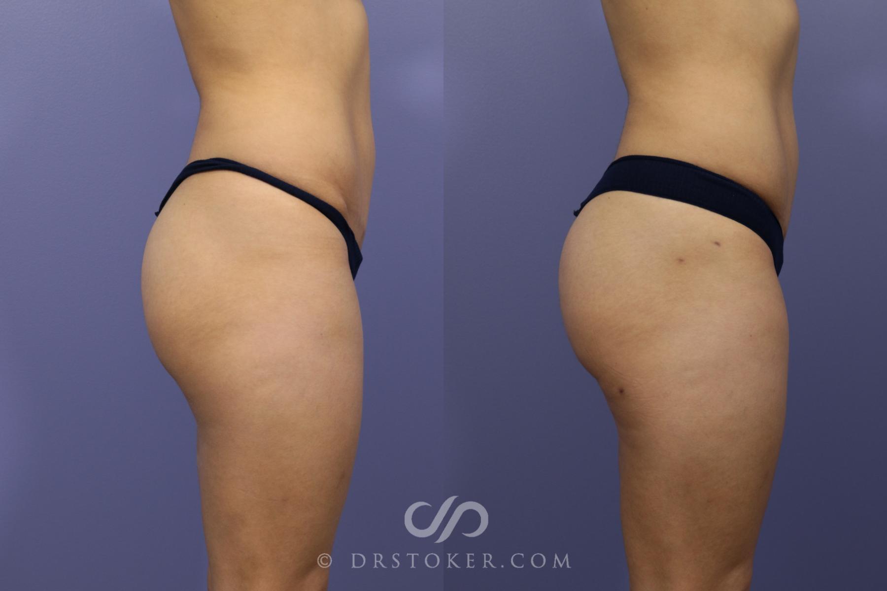 Before & After Liposuction Case 982 View #2 View in Los Angeles, CA