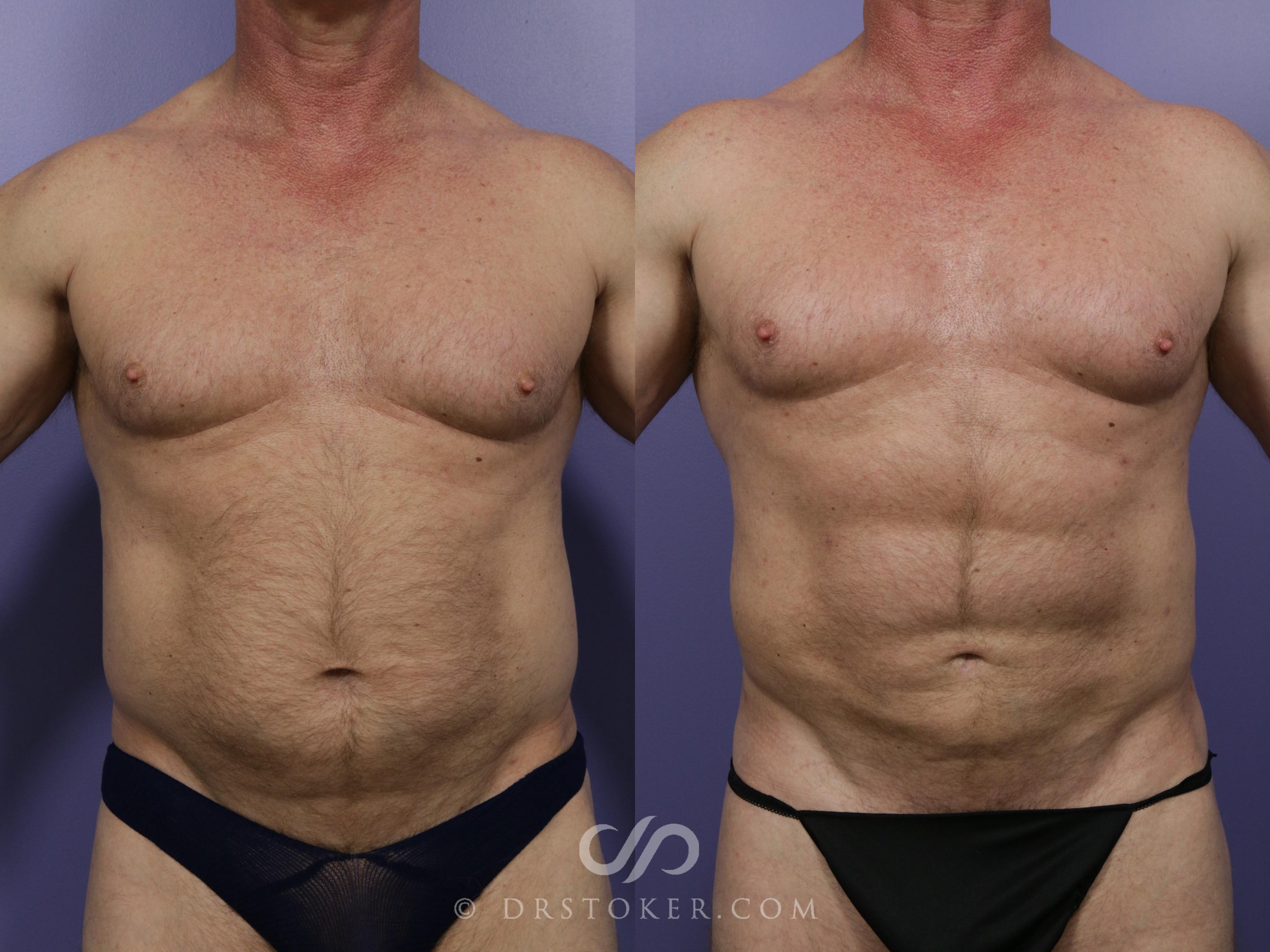 Before & After Liposuction Case 987 View #1 View in Los Angeles, CA