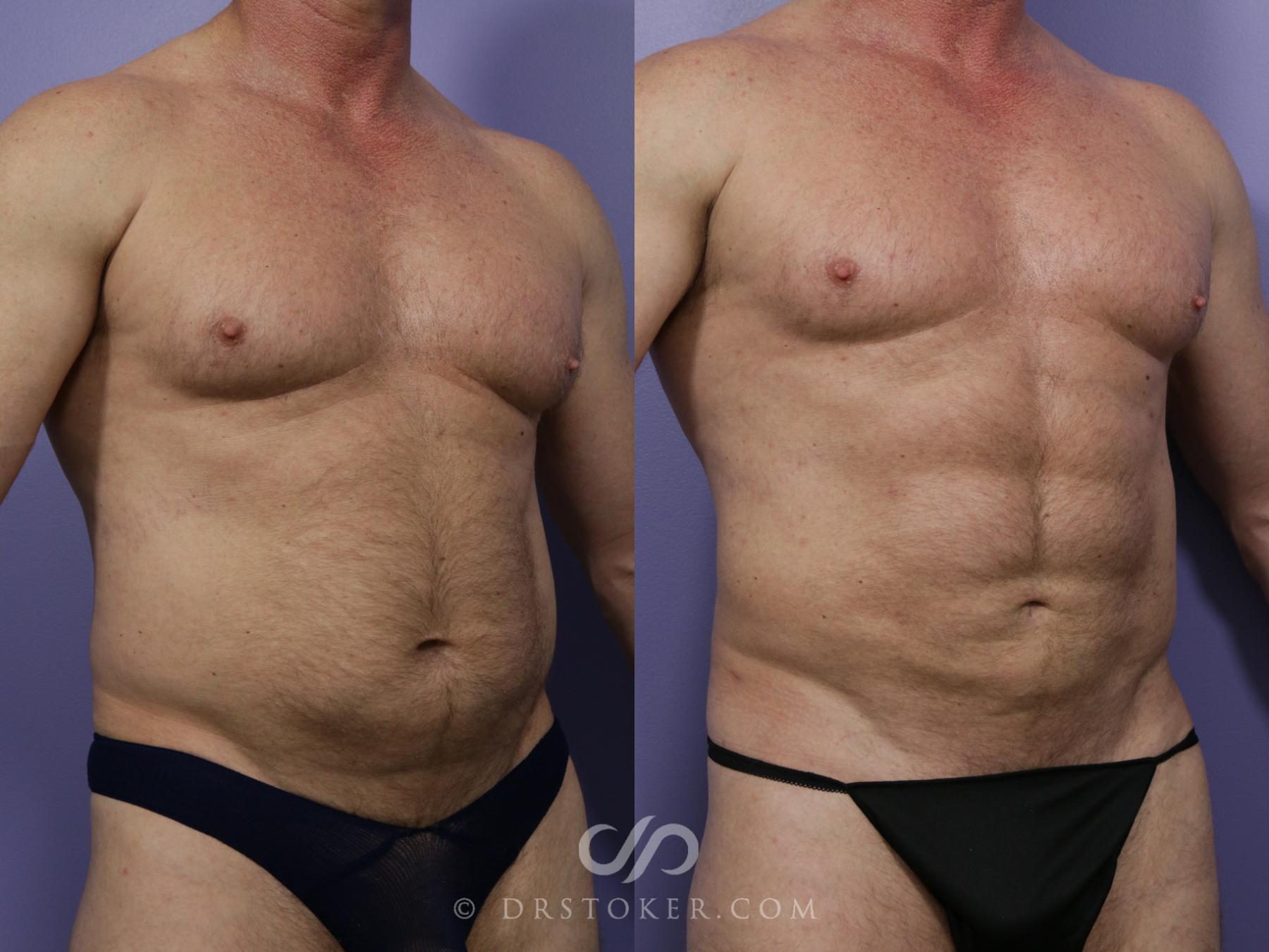 Before & After Liposuction Case 987 View #2 View in Los Angeles, CA