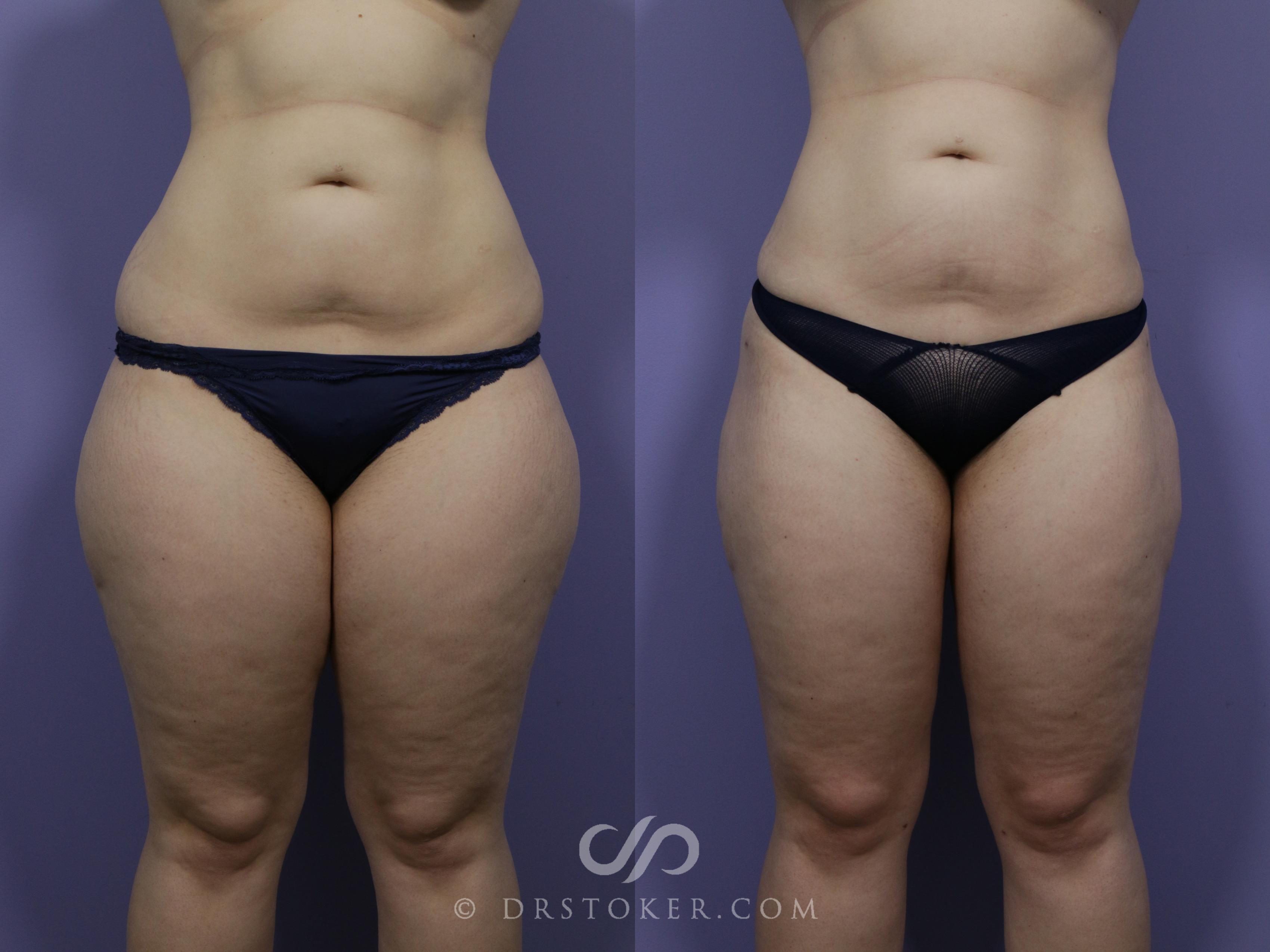 Before & After Liposuction Case 988 View #1 View in Los Angeles, CA