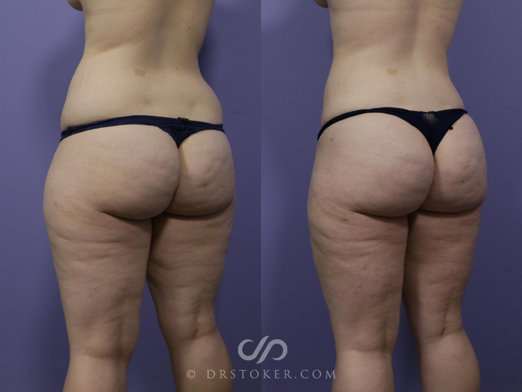 Before & After Liposuction Case 988 View #2 View in Los Angeles, CA