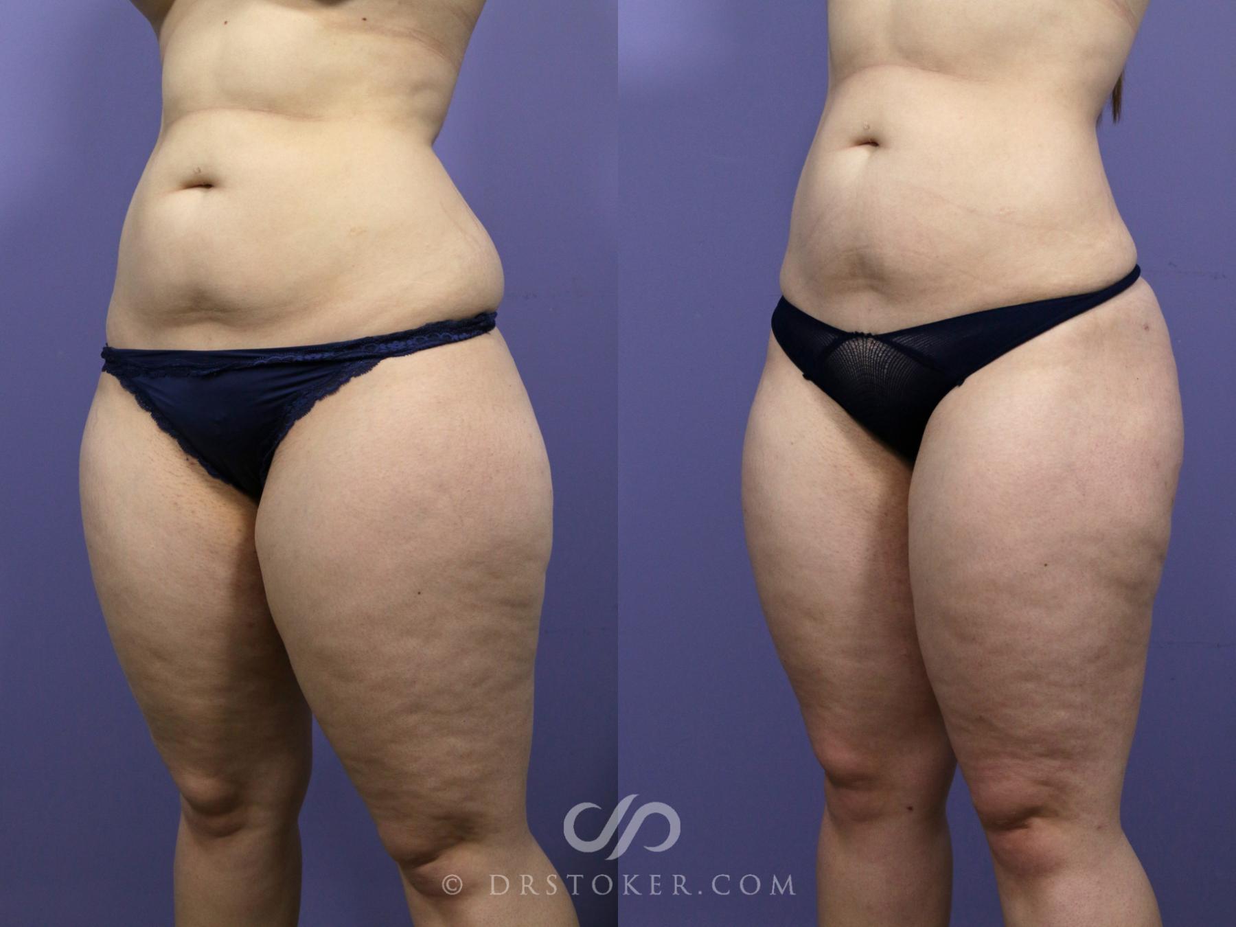 Before & After Liposuction Case 989 View #2 View in Los Angeles, CA