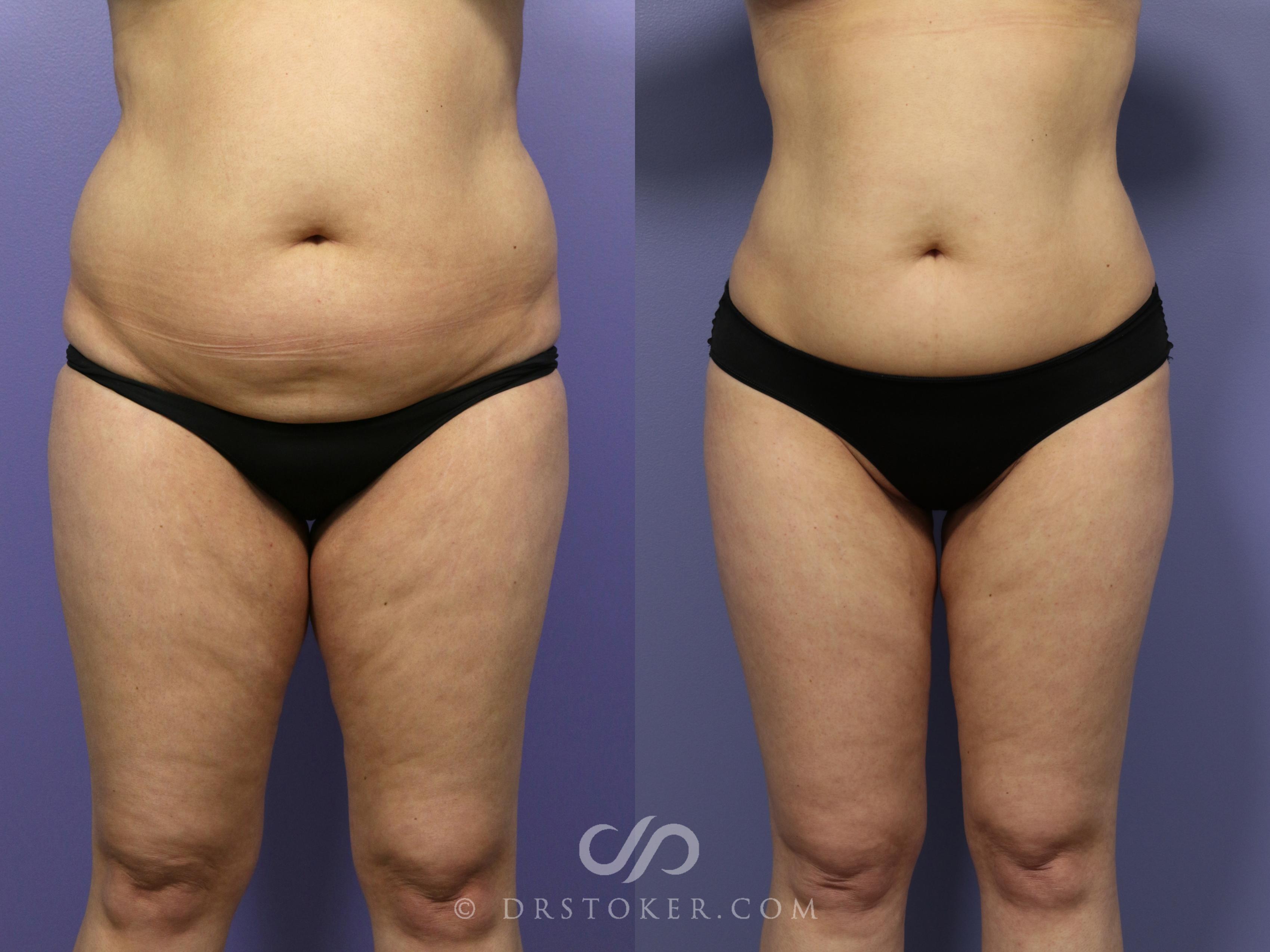 Before & After Liposuction Case 990 View #1 View in Los Angeles, CA