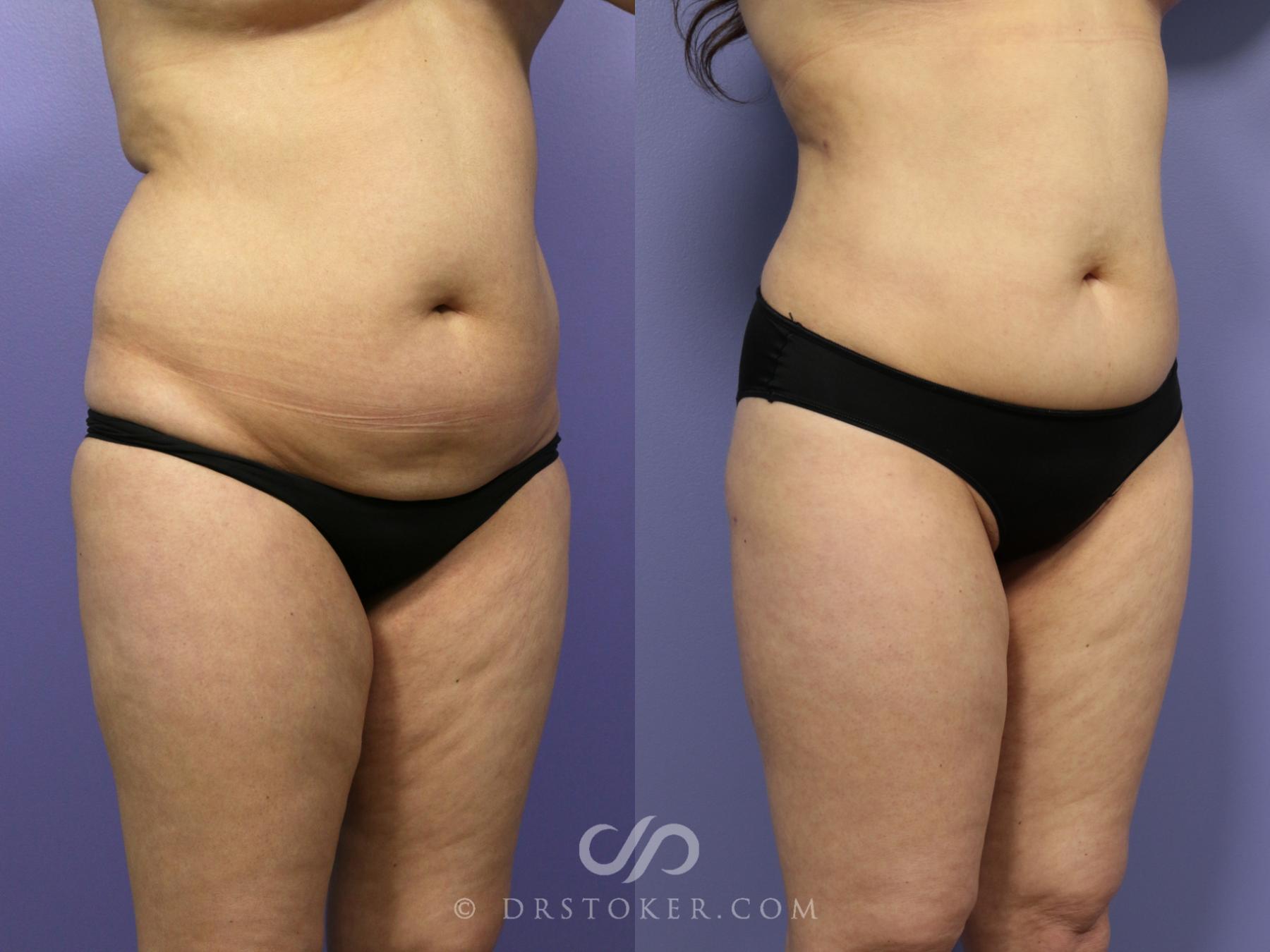 Before & After Liposuction Case 990 View #2 View in Los Angeles, CA
