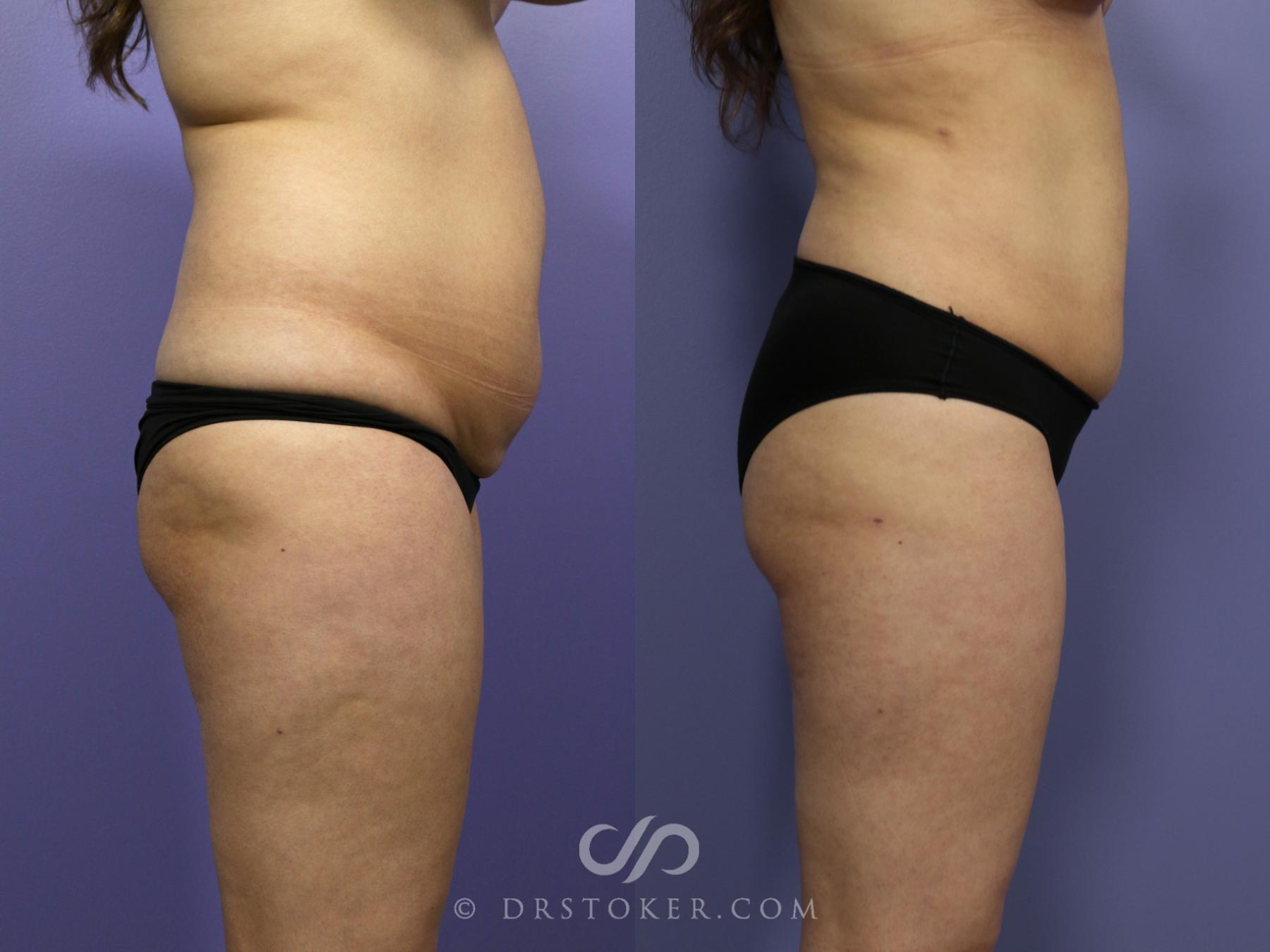 Before & After Liposuction Case 990 View #3 View in Los Angeles, CA