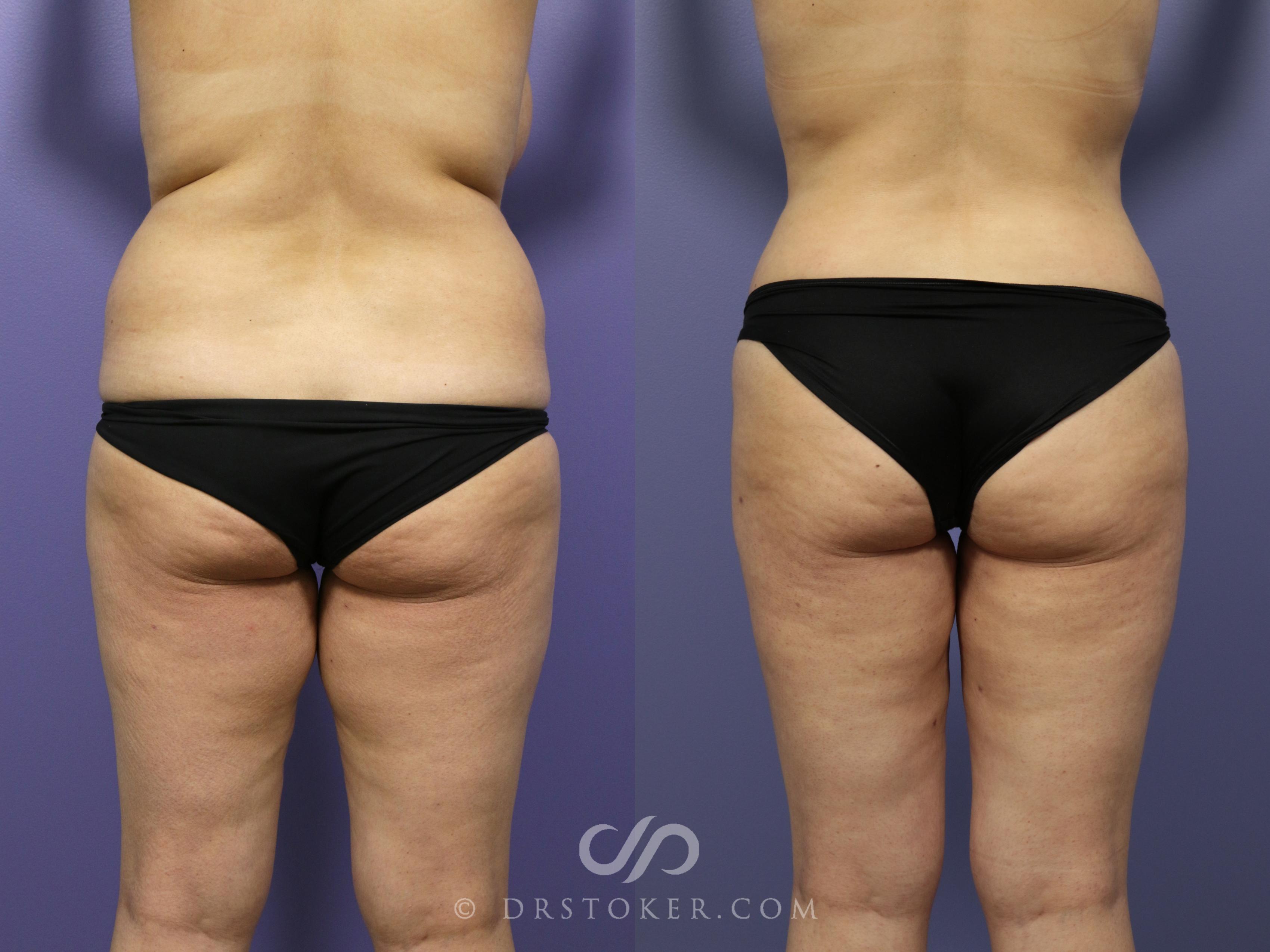 Before & After Liposuction Case 991 View #1 View in Los Angeles, CA