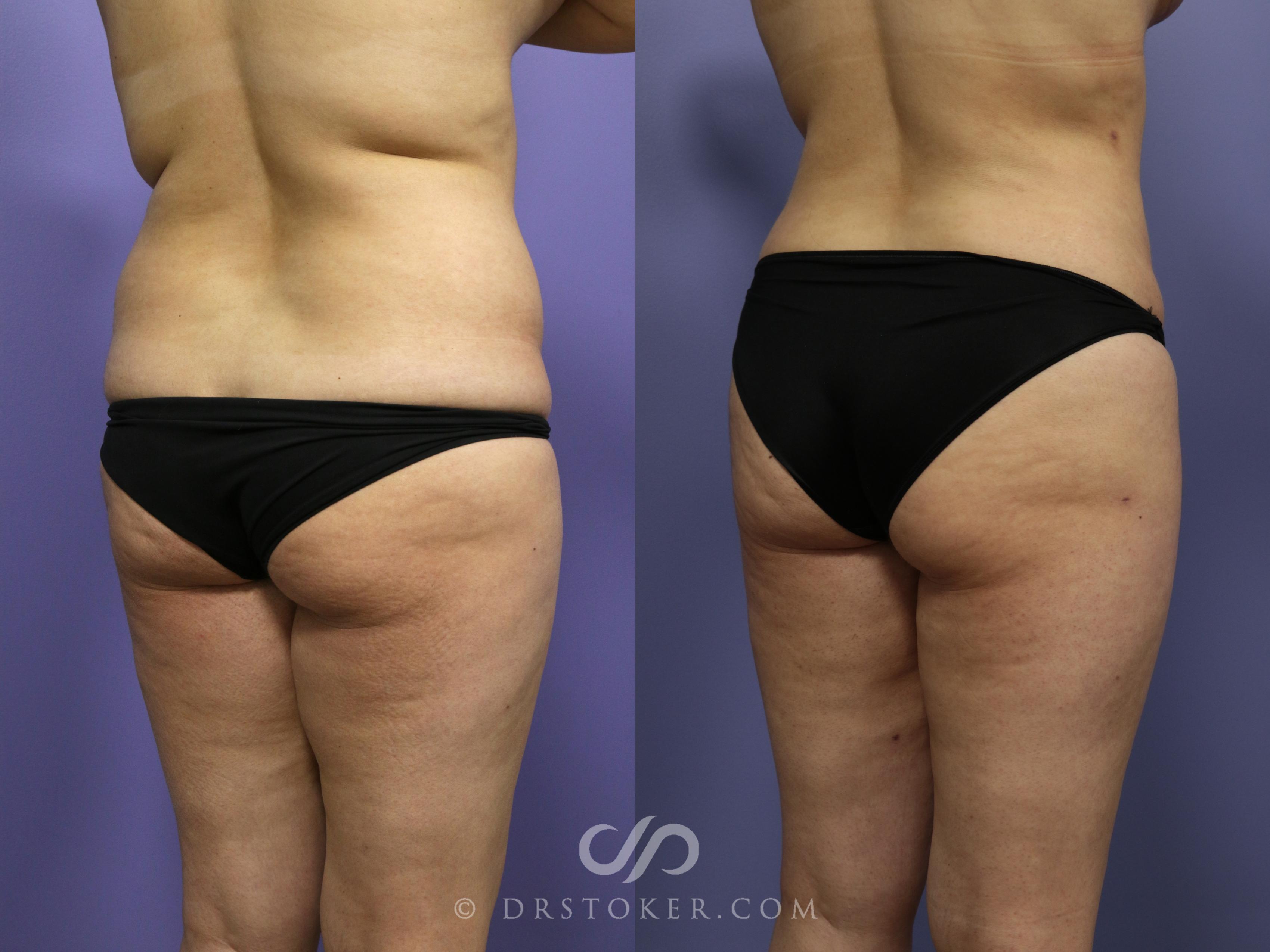 Before & After Liposuction Case 991 View #2 View in Los Angeles, CA