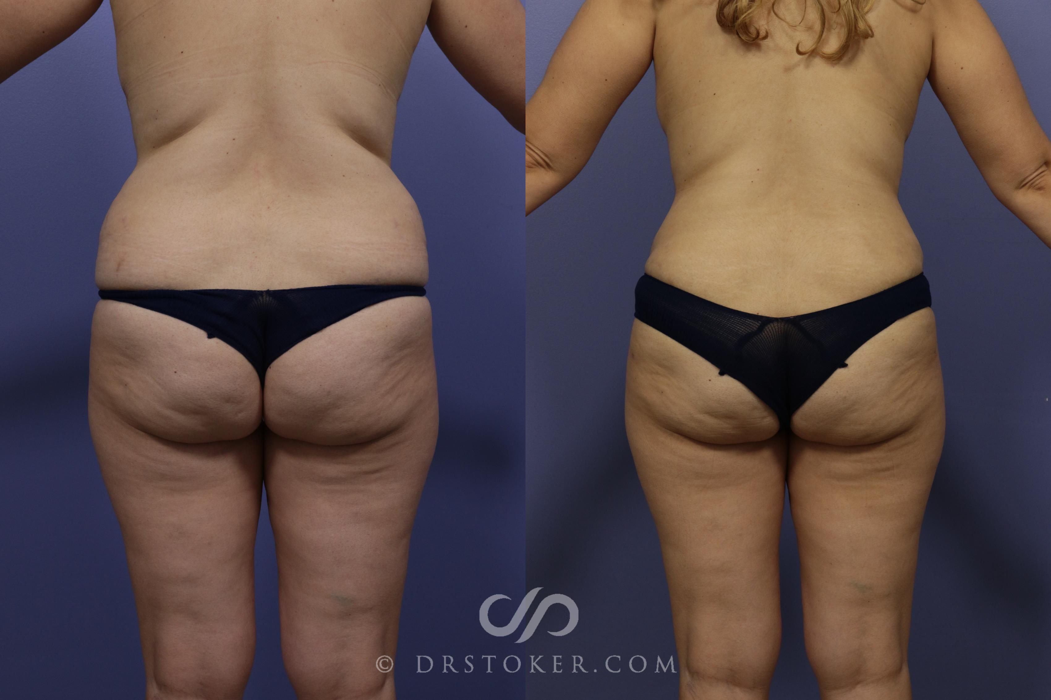 Before & After Liposuction Case 992 View #1 View in Los Angeles, CA