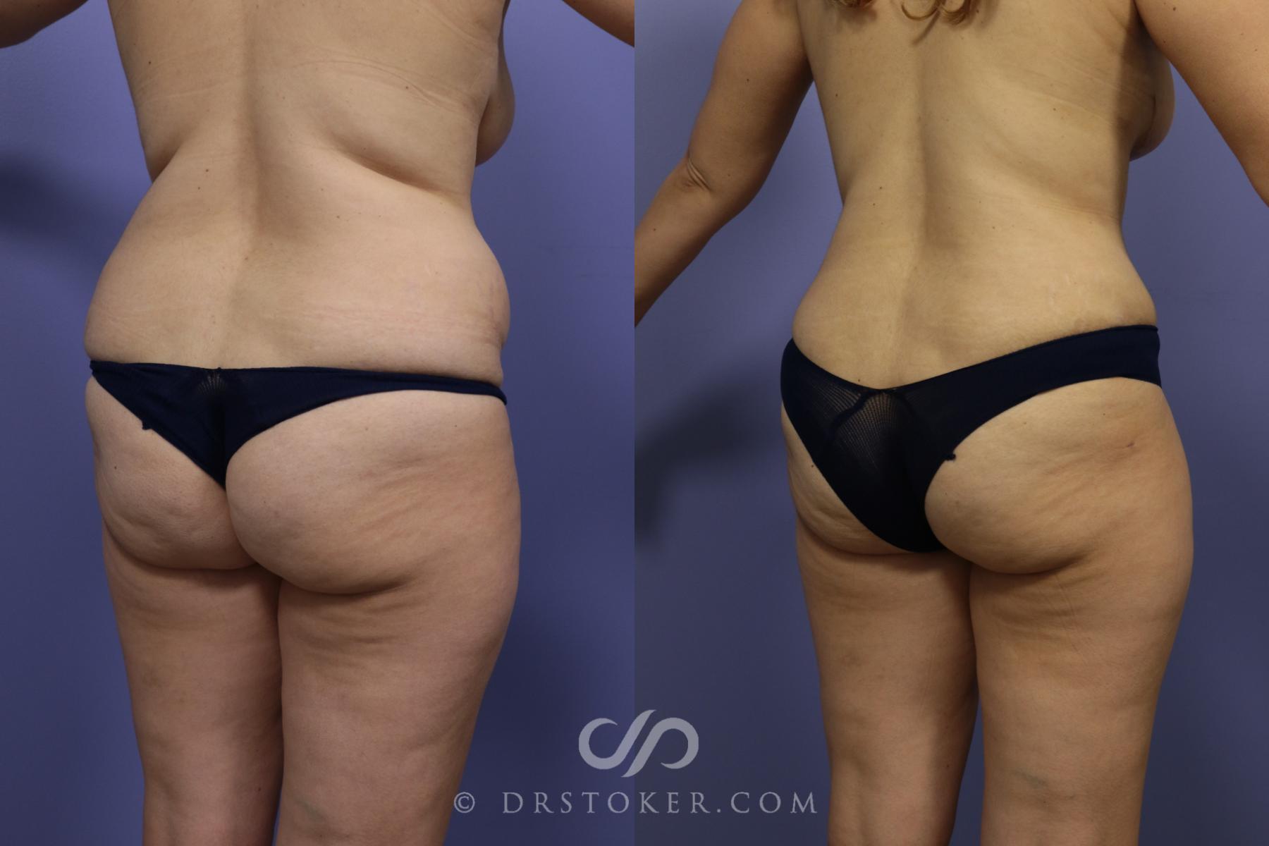 Before & After Liposuction Case 992 View #2 View in Los Angeles, CA