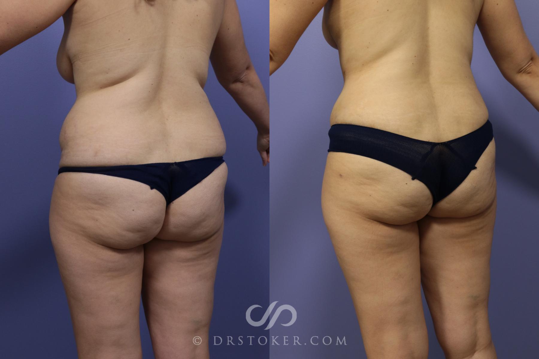 Before & After Liposuction Case 992 View #3 View in Los Angeles, CA