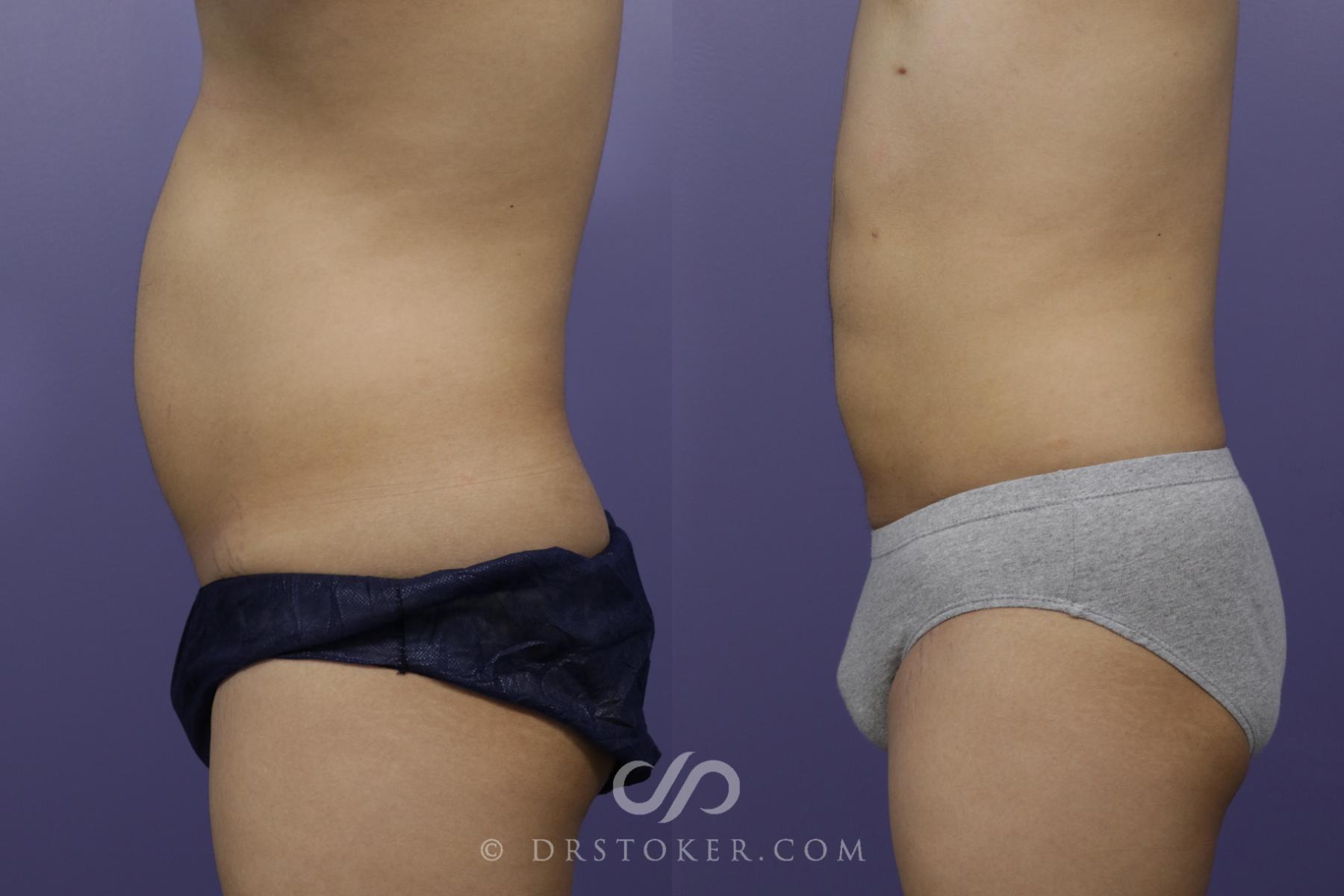 Before & After Liposuction - Abdominal Etching & Sculpting Case 1335 View #1 View in Los Angeles, CA