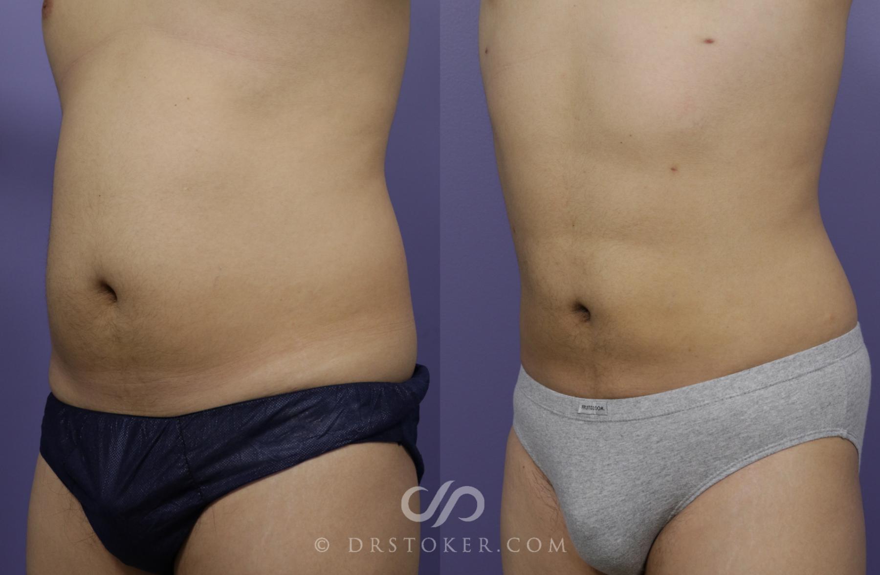 Before & After Liposuction - Abdominal Etching & Sculpting Case 1335 View #2 View in Los Angeles, CA