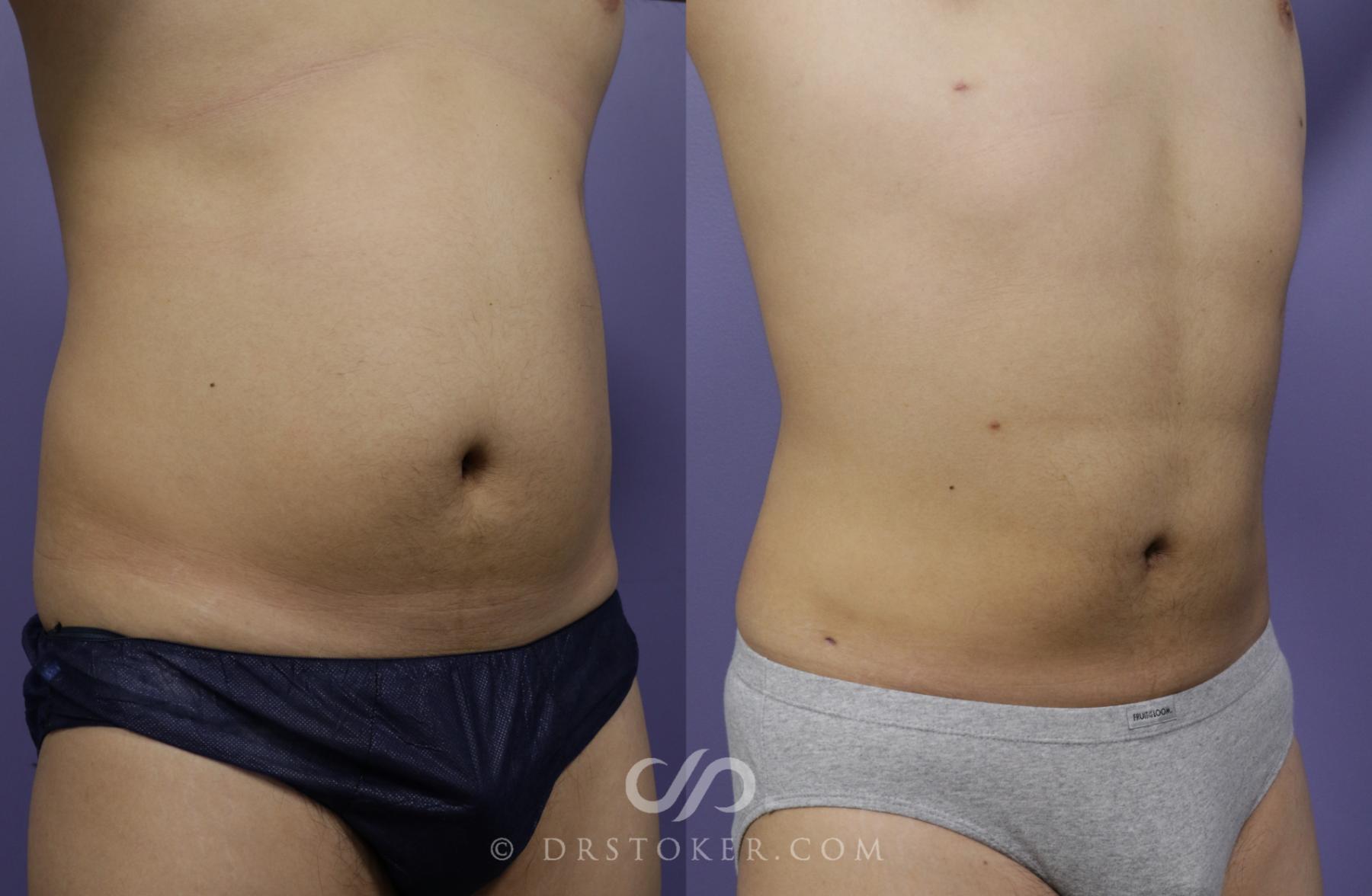 Before & After Liposuction Case 1336 View #1 View in Los Angeles, CA