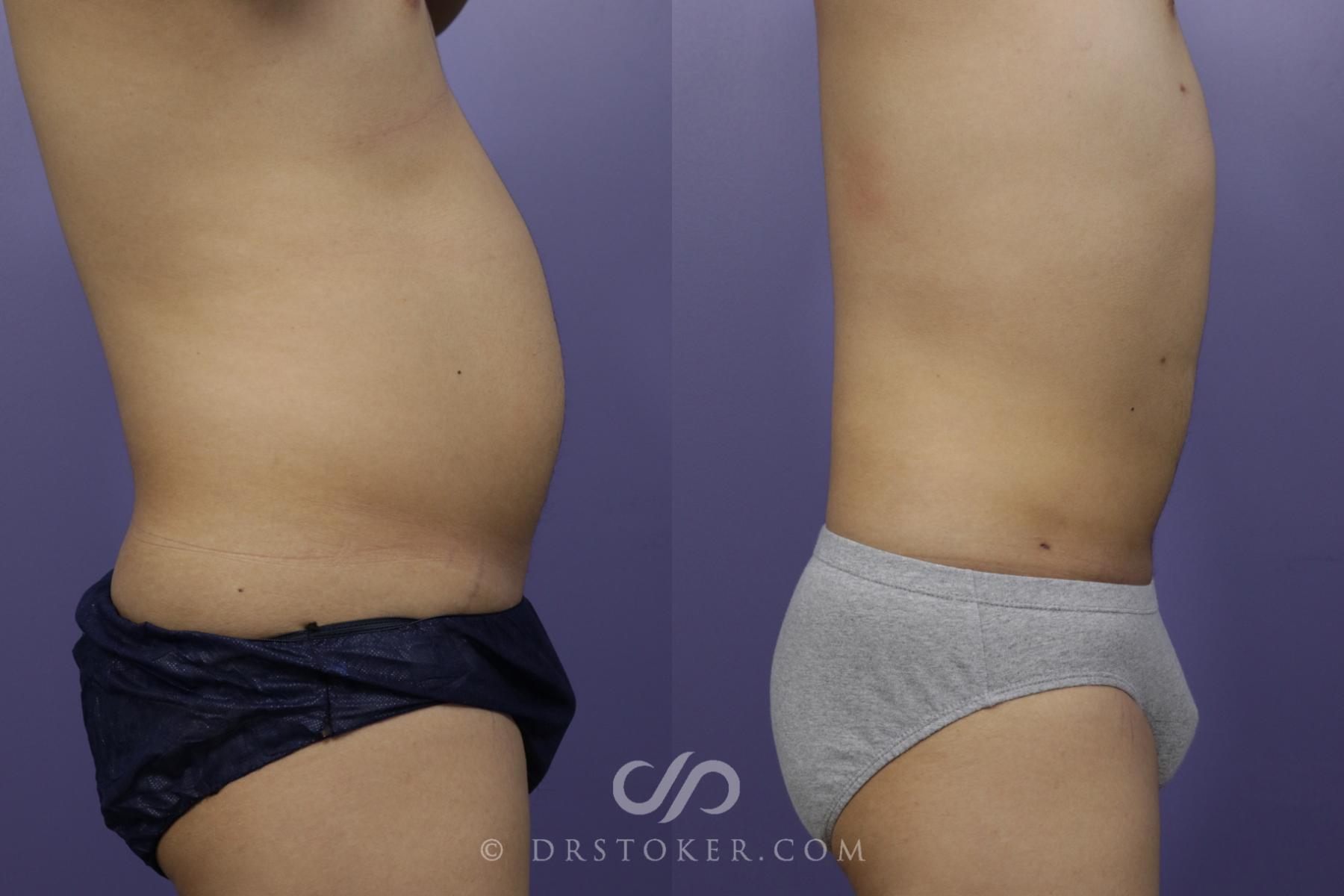 Before & After Liposuction Case 1336 View #2 View in Los Angeles, CA