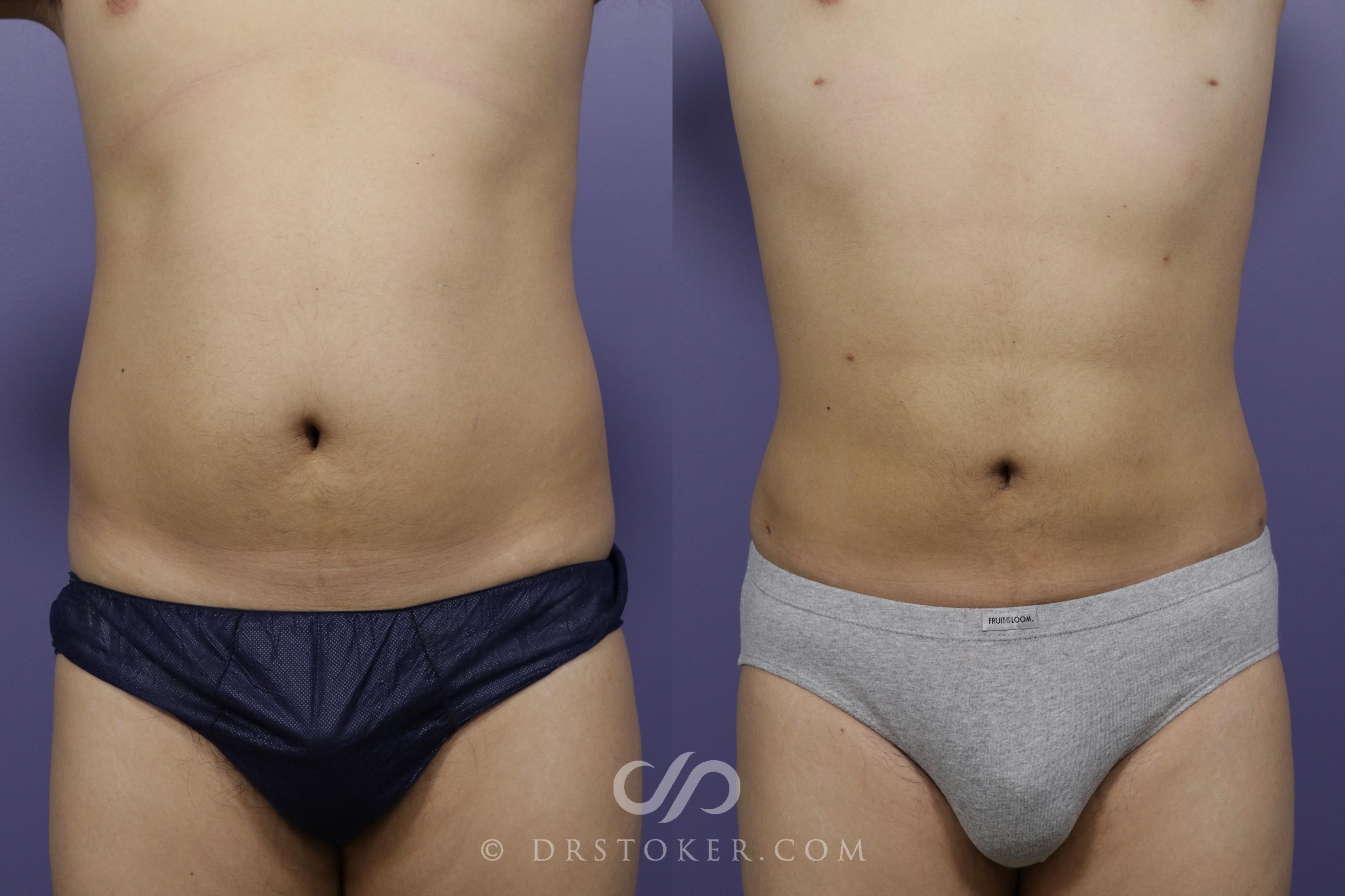 Before & After Liposuction Case 1337 View #1 View in Los Angeles, CA