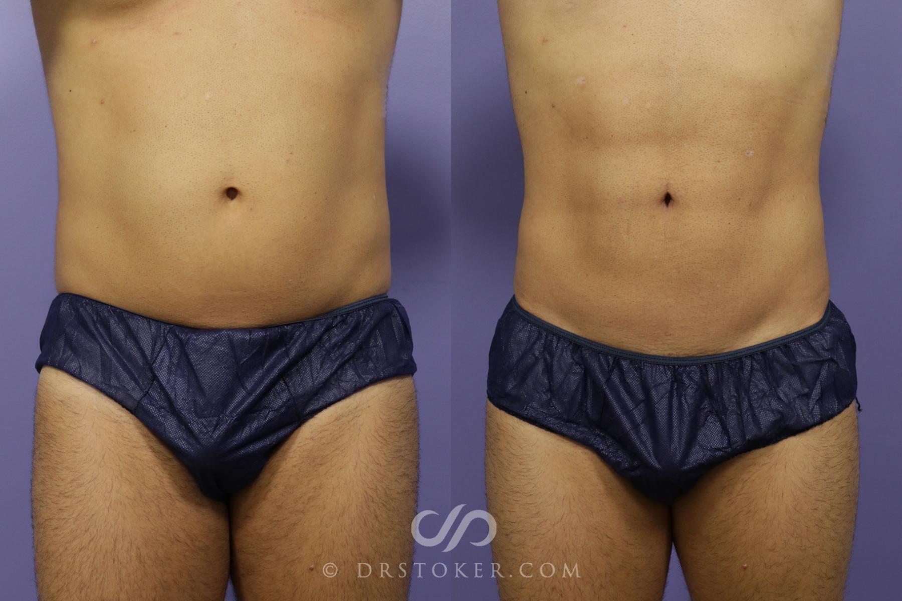 Before & After Liposuction - Abdominal Etching & Sculpting Case 1338 View #1 View in Los Angeles, CA