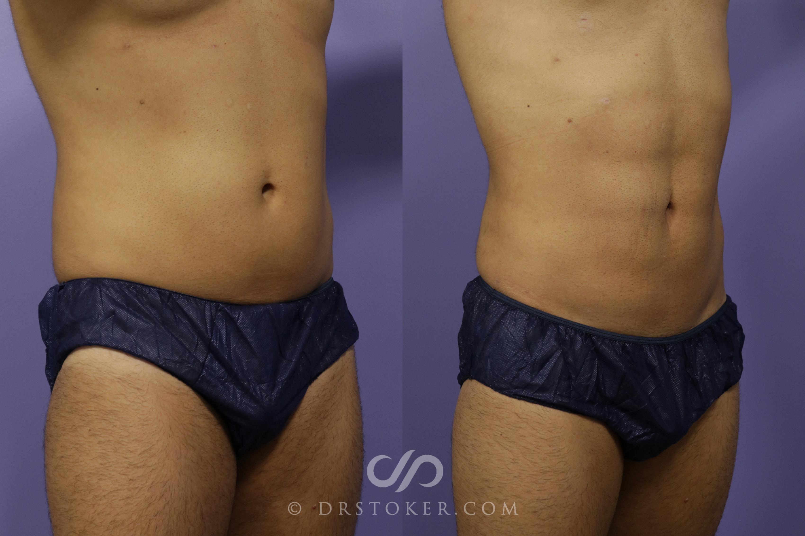 Before & After Liposuction Case 1339 View #1 View in Los Angeles, CA