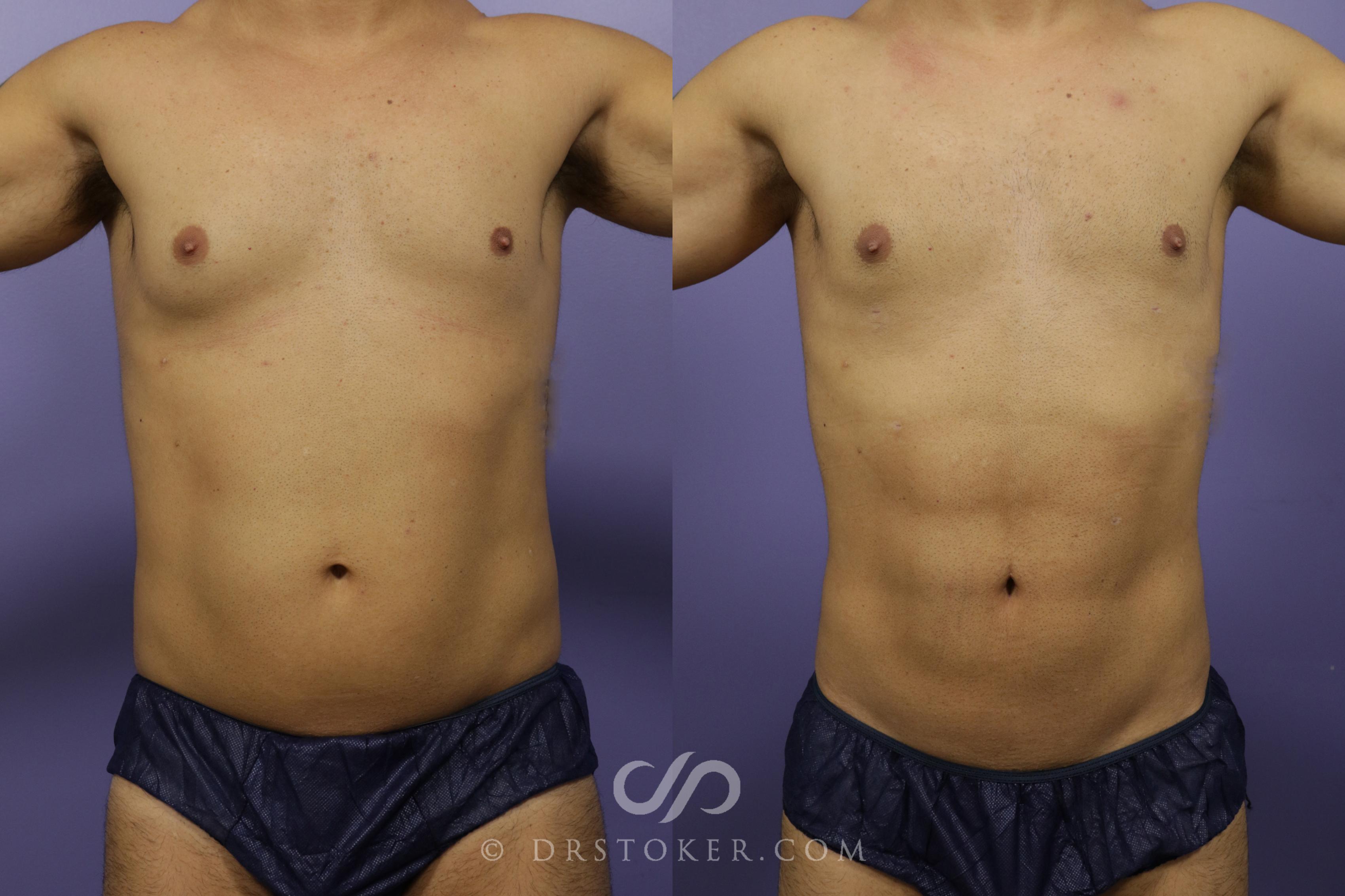 Before & After Liposuction Case 1340 View #1 View in Los Angeles, CA