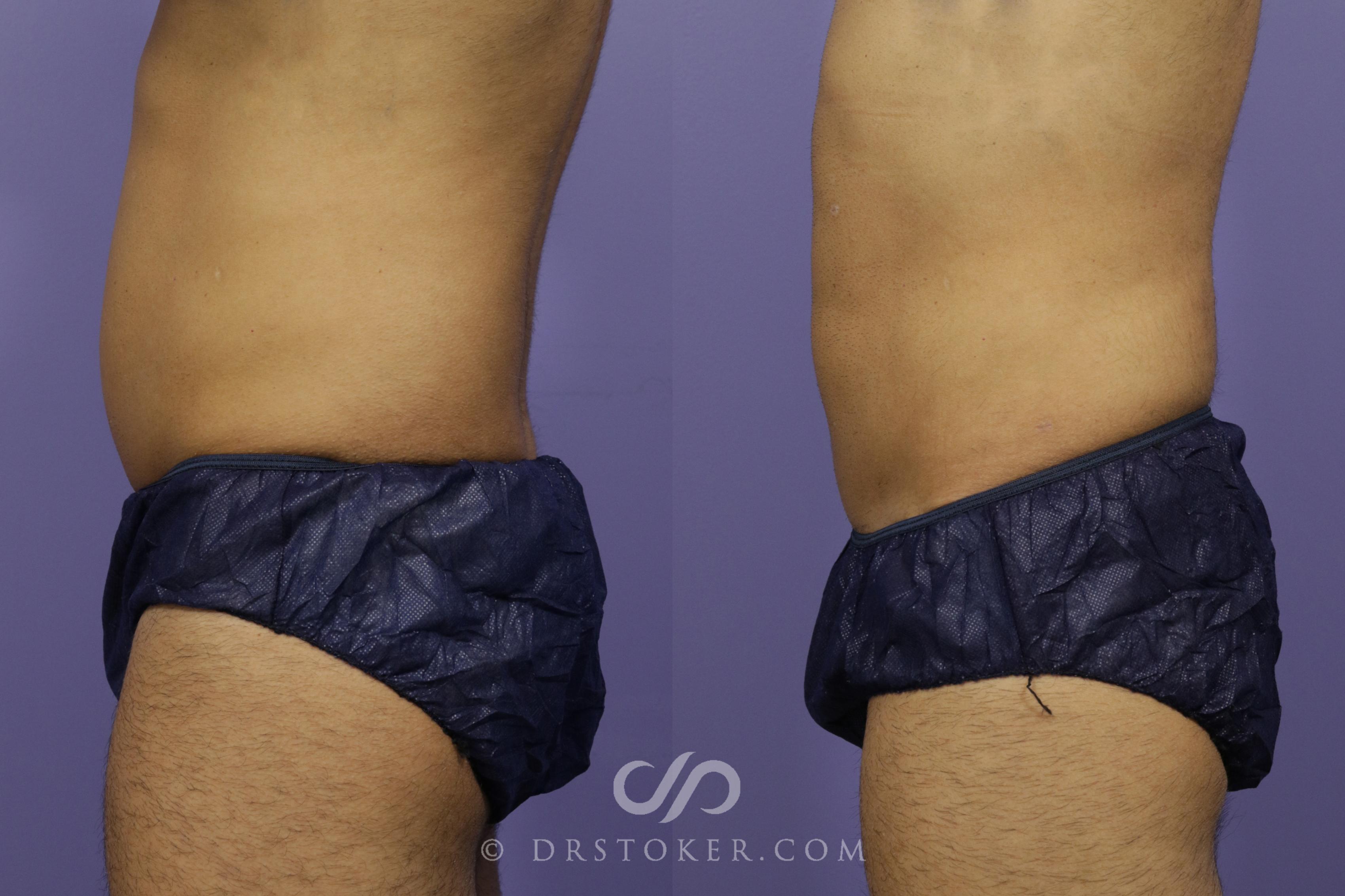 Before & After Liposuction - Abdominal Etching & Sculpting Case 1341 View #1 View in Los Angeles, CA