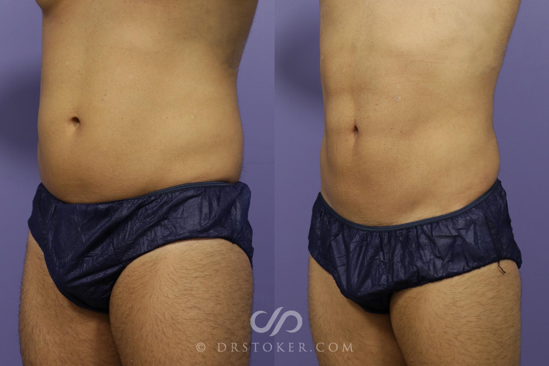 Before & After Liposuction - Abdominal Etching & Sculpting Case 1342 View #1 View in Los Angeles, CA
