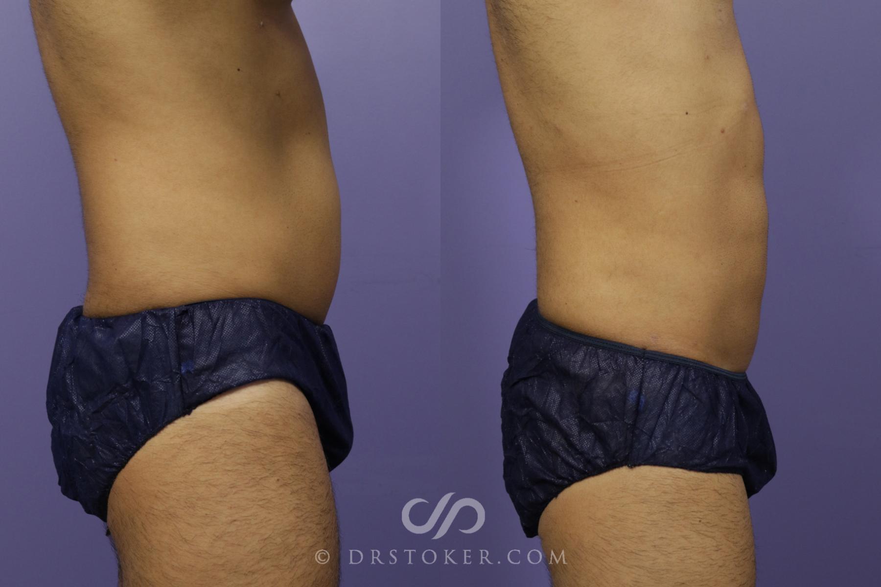 Before & After Liposuction Case 1343 View #1 View in Los Angeles, CA