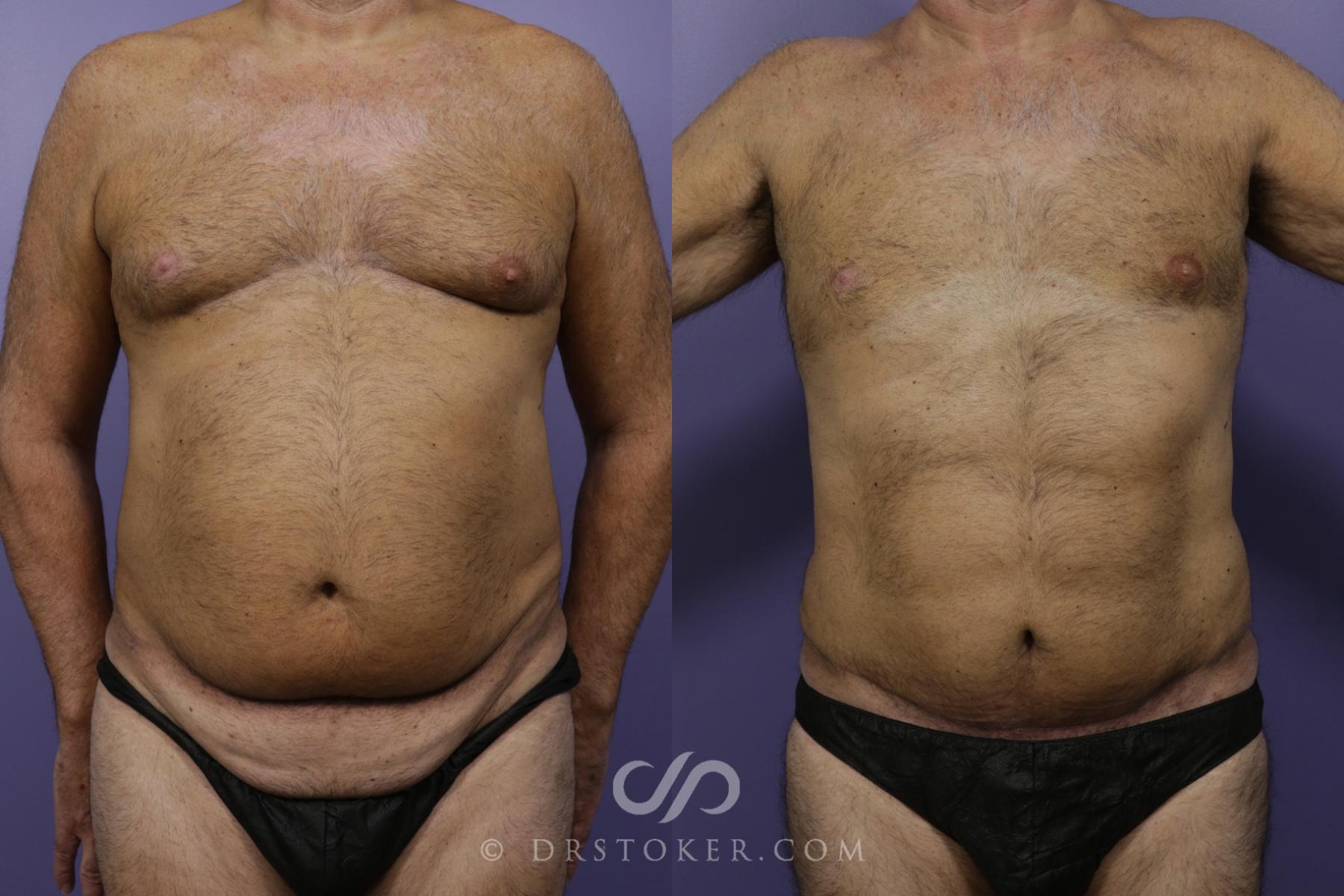 Before & After Liposuction - Abdominal Etching & Sculpting Case 1344 View #1 View in Los Angeles, CA
