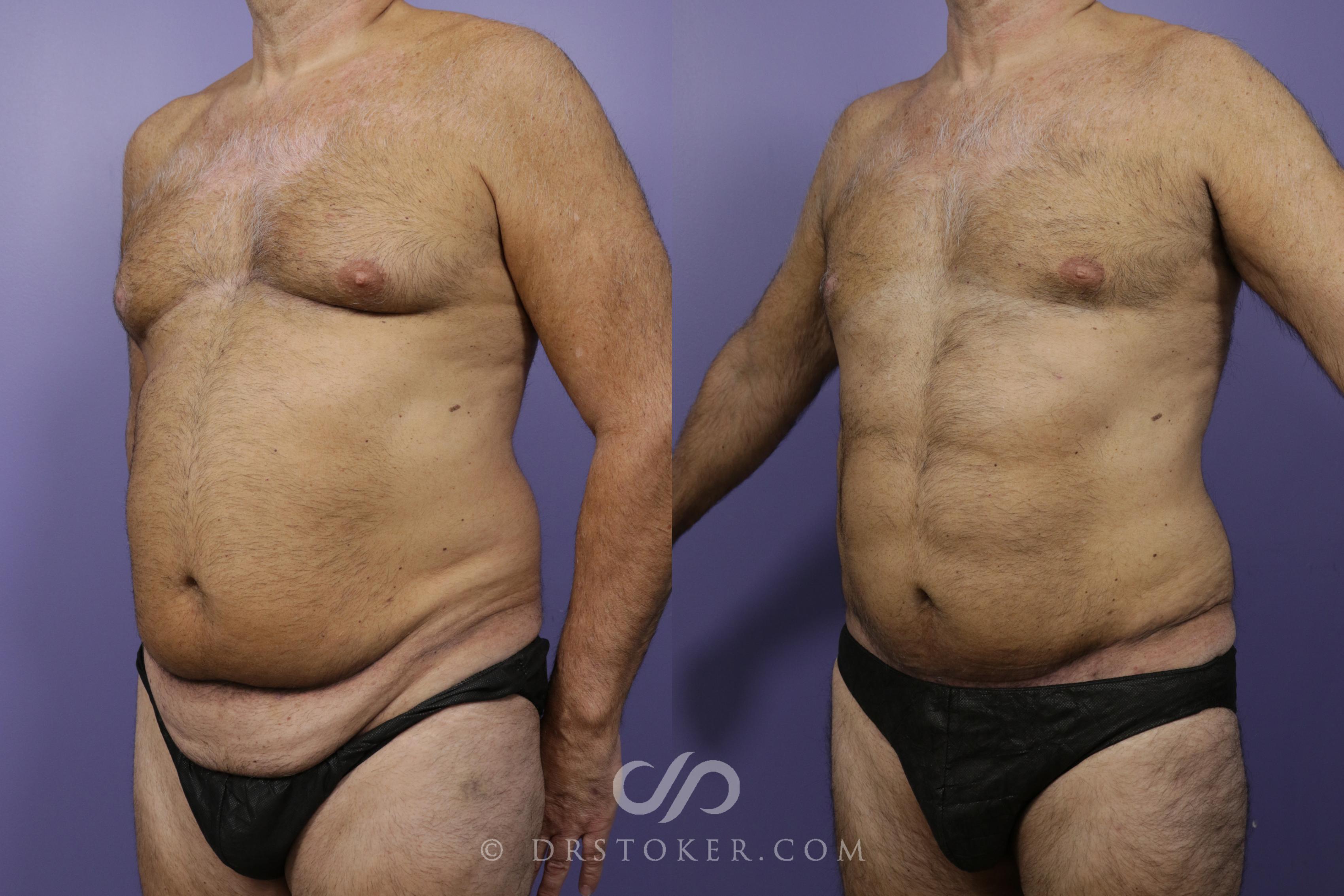 Before & After Liposuction - Abdominal Etching & Sculpting Case 1345 View #1 View in Los Angeles, CA